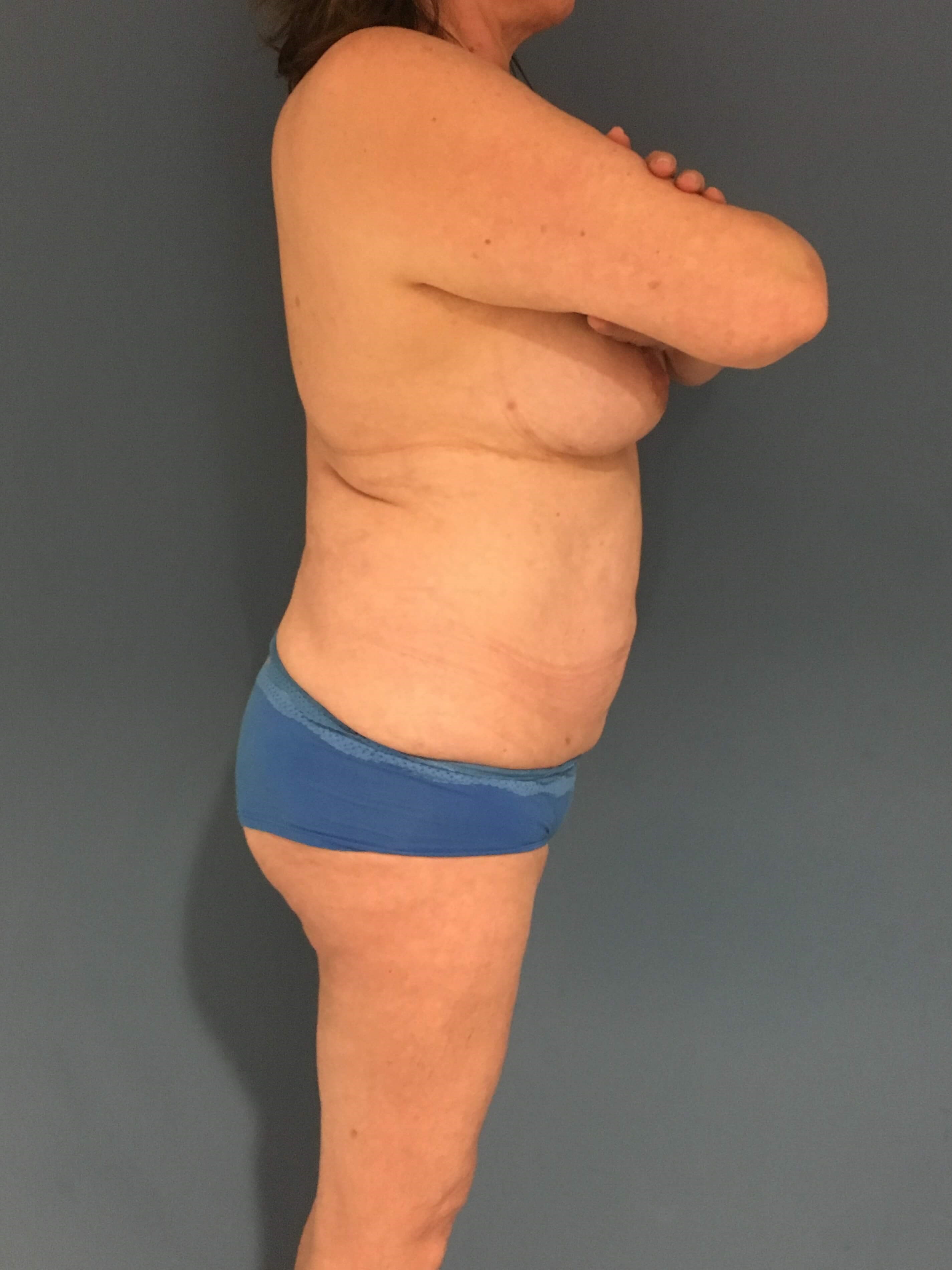 Menopause Makeover with Removal of Bilateral Breast Implants and Fat Transfer — after, view 3