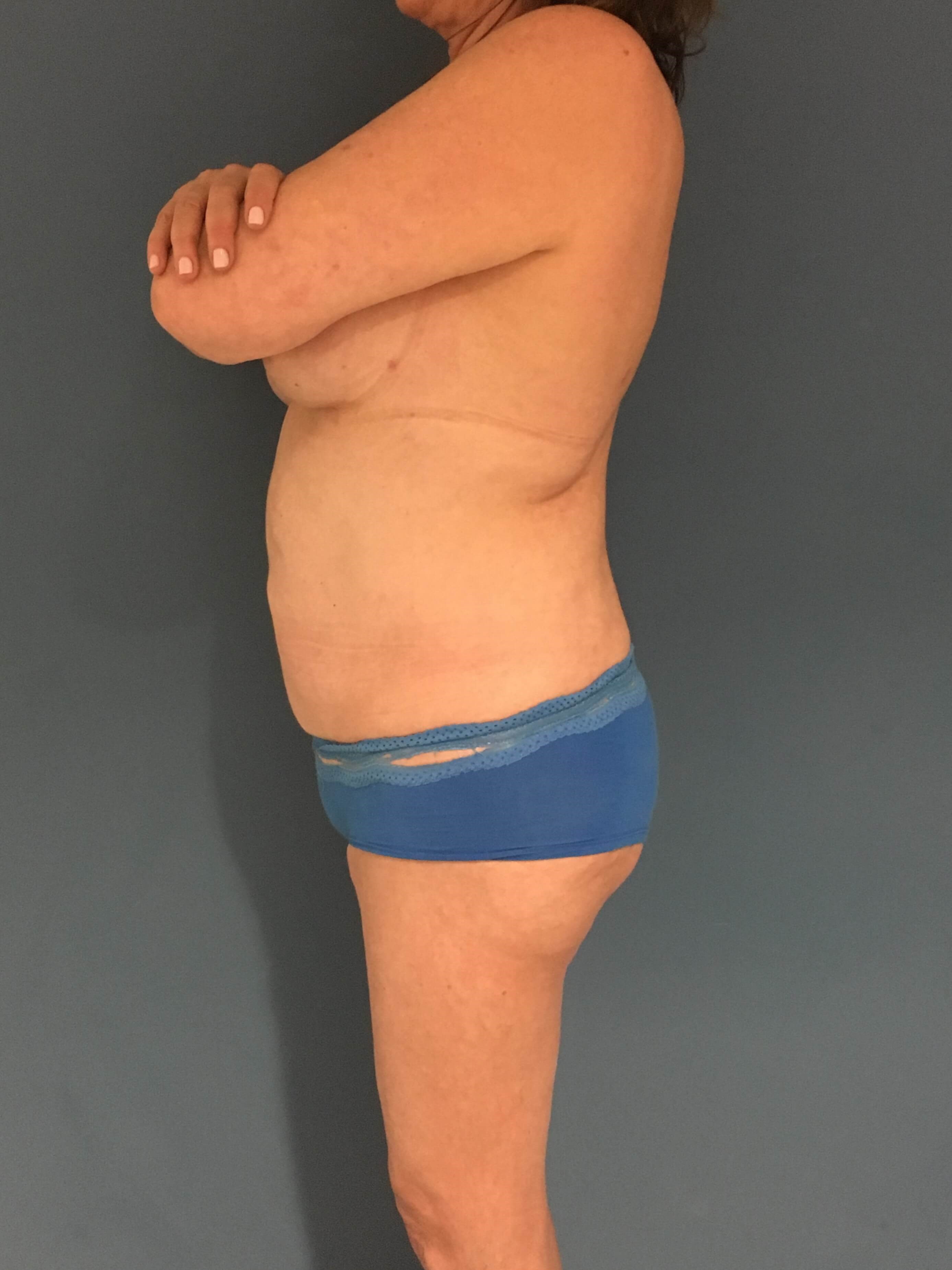 Menopause Makeover with Removal of Bilateral Breast Implants and Fat Transfer — after, view 4