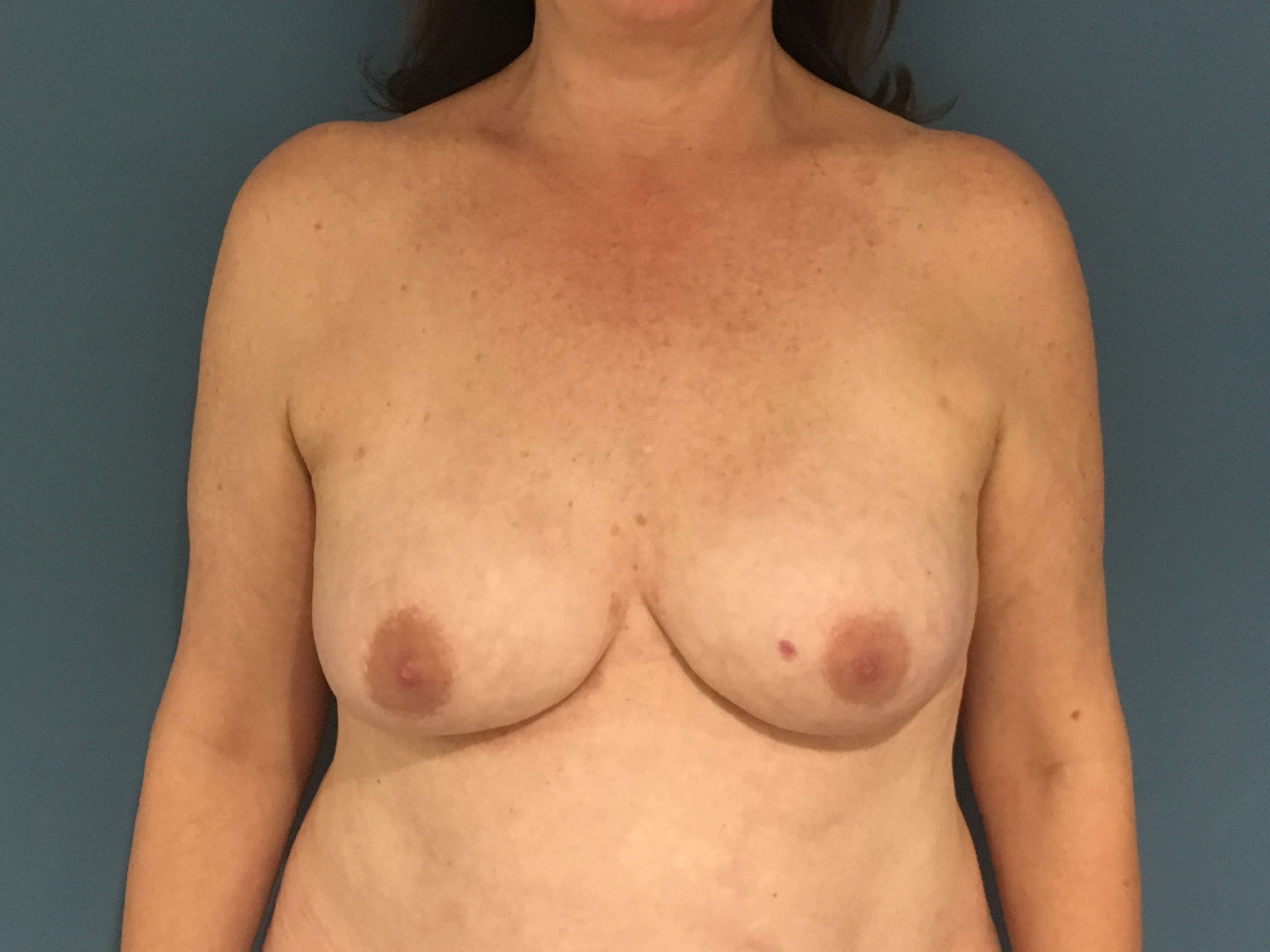 Menopause Makeover with Removal of Bilateral Breast Implants and Fat Transfer — after, view 5