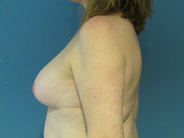 Menopause Makeover with Removal of Bilateral Breast Implants and Fat Transfer — before, view 6