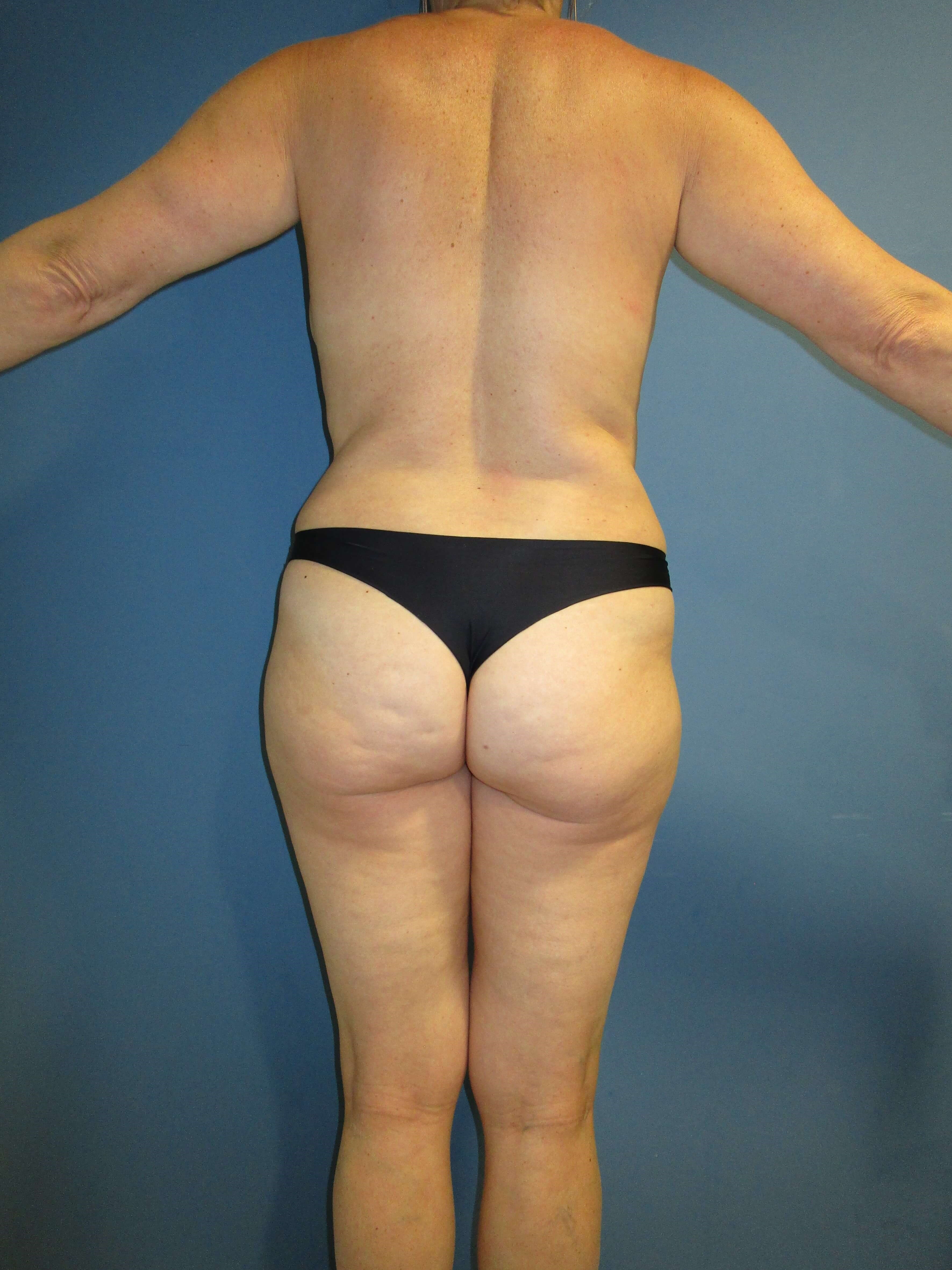 Menopause Makeover in Fifty-One Year-Old Calabasas Woman — before, view 3