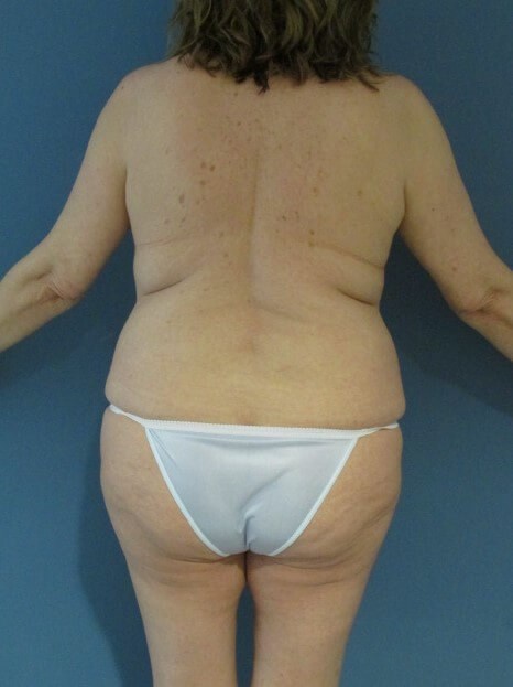 Menopause Makeover with Removal of Bilateral Breast Implants and Fat Transfer — before, view 2