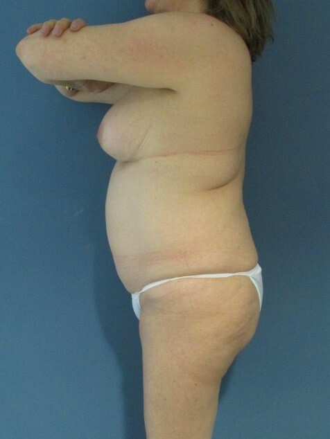 Menopause Makeover with Removal of Bilateral Breast Implants and Fat Transfer — before, view 4