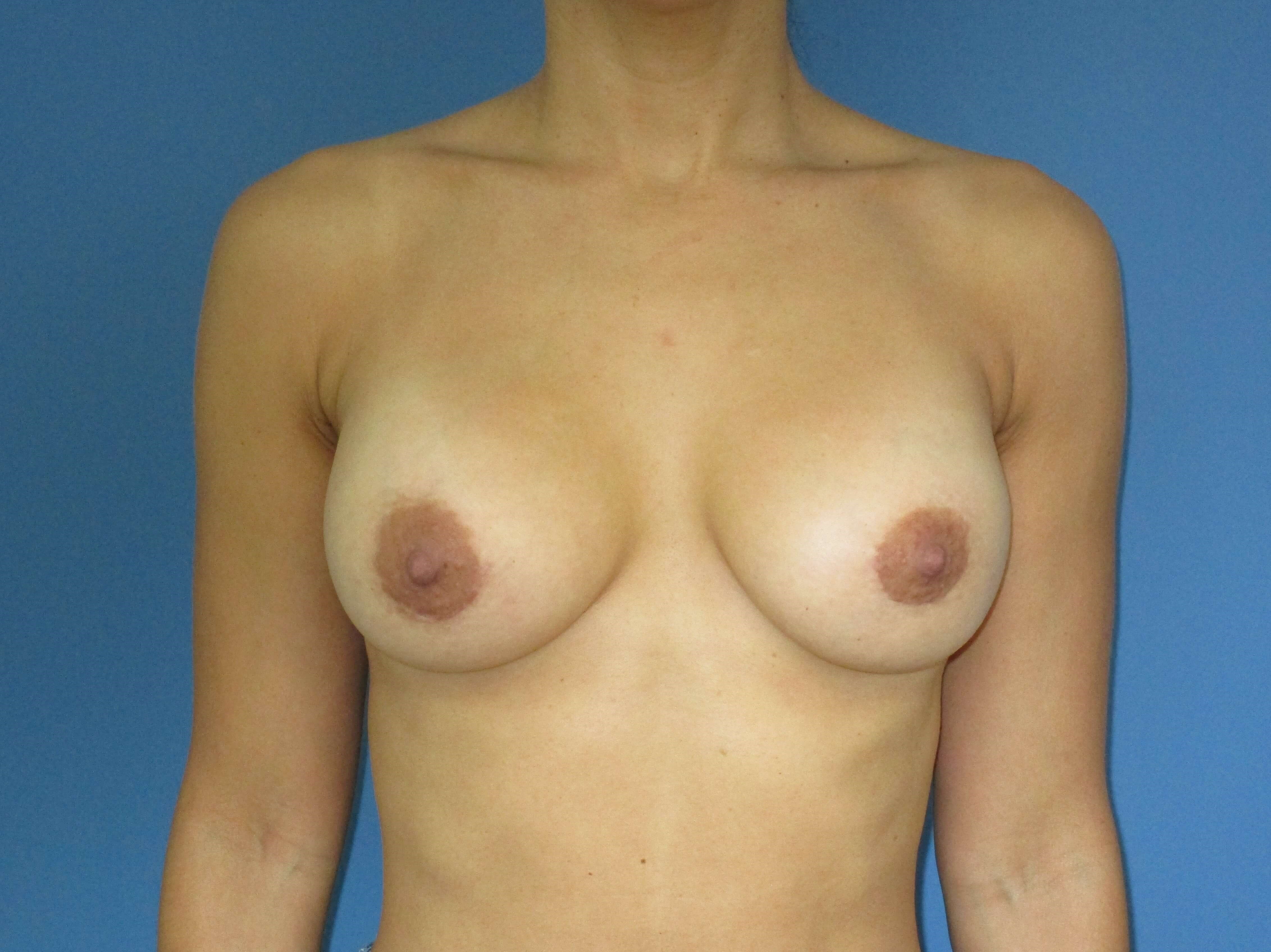 Removal and Replacement of Implants