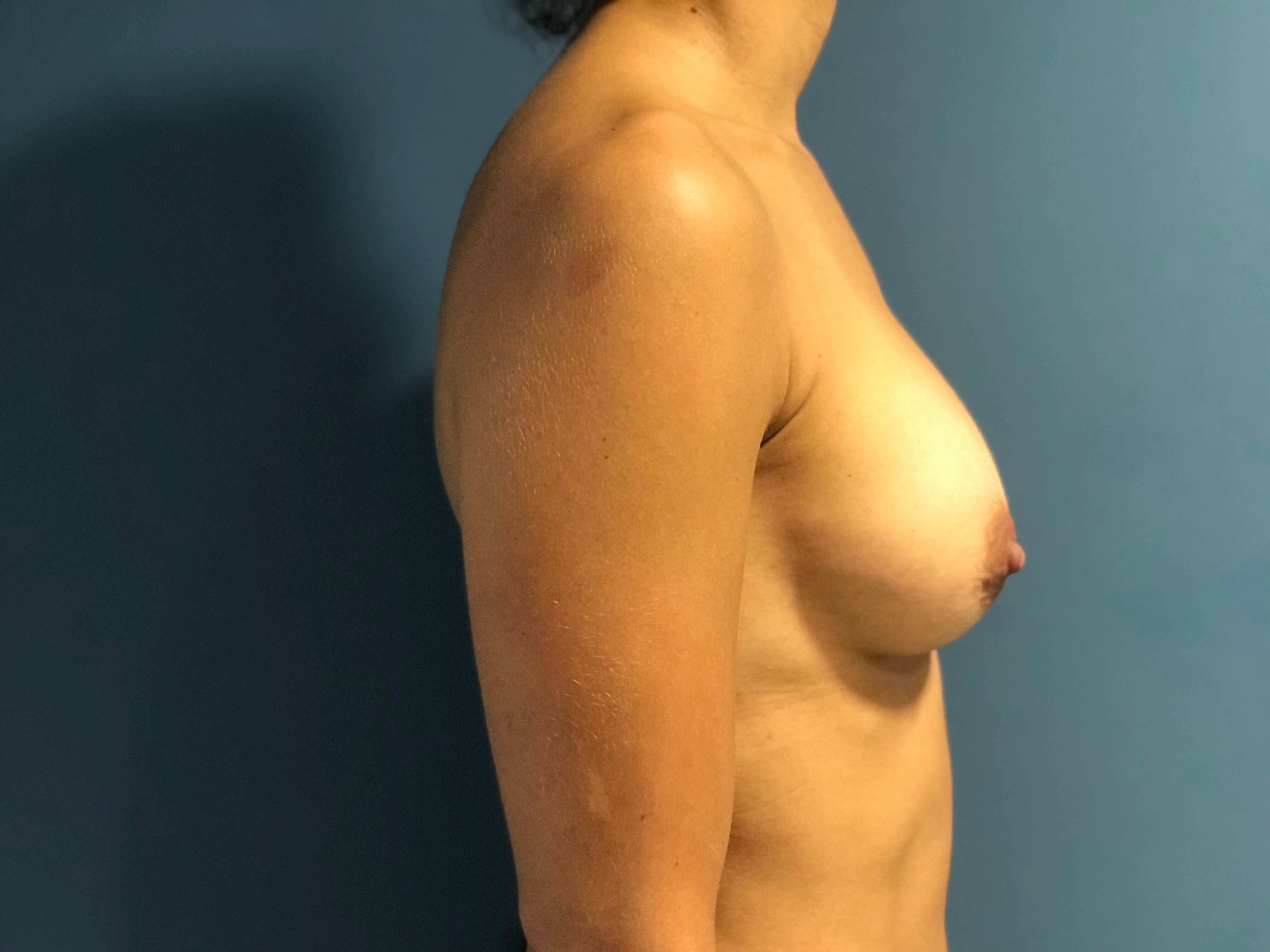 Removal and Replacement of Implants — before, view 3