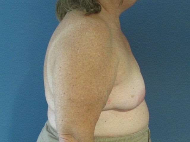 Sixty-Five Year-Old Woman Six Weeks S/p Immediate Breast Reconstruction — before, view 3