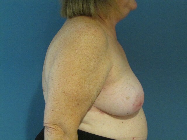 Sixty-Five Year-Old Woman Six Weeks S/p Immediate Breast Reconstruction — after, view 3