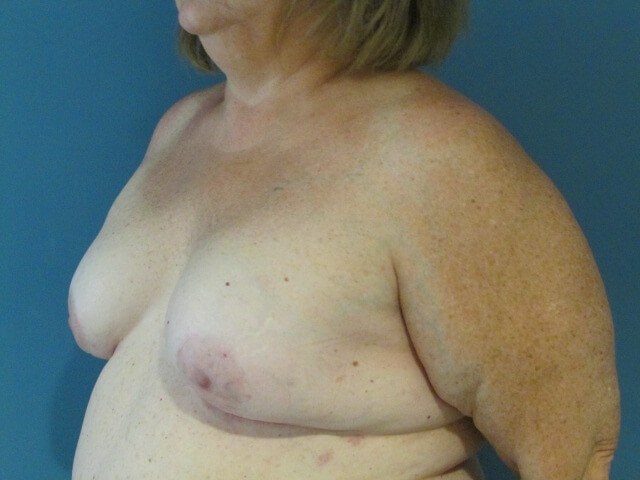 Sixty-Five Year-Old Woman Six Weeks S/p Immediate Breast Reconstruction — before, view 4