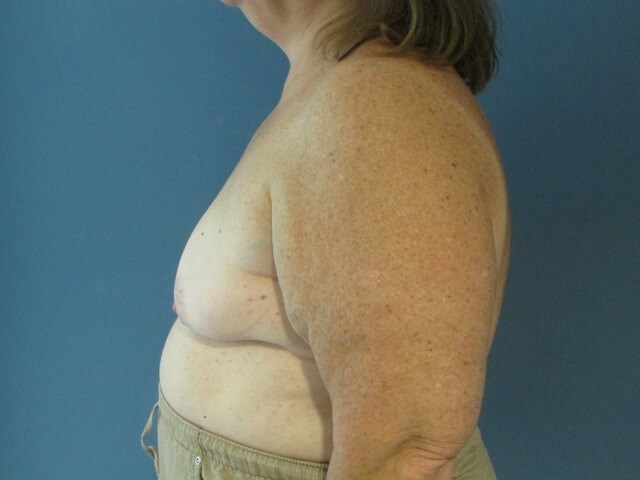 Sixty-Five Year-Old Woman Six Weeks S/p Immediate Breast Reconstruction — before, view 5
