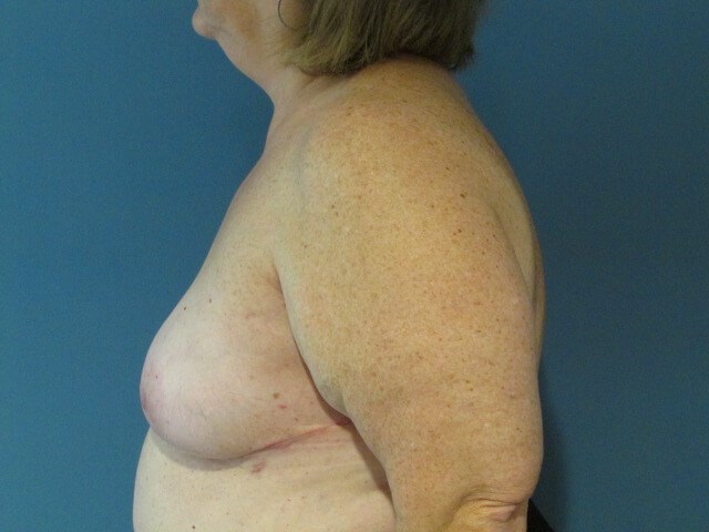 Sixty-Five Year-Old Woman Six Weeks S/p Immediate Breast Reconstruction — after, view 5