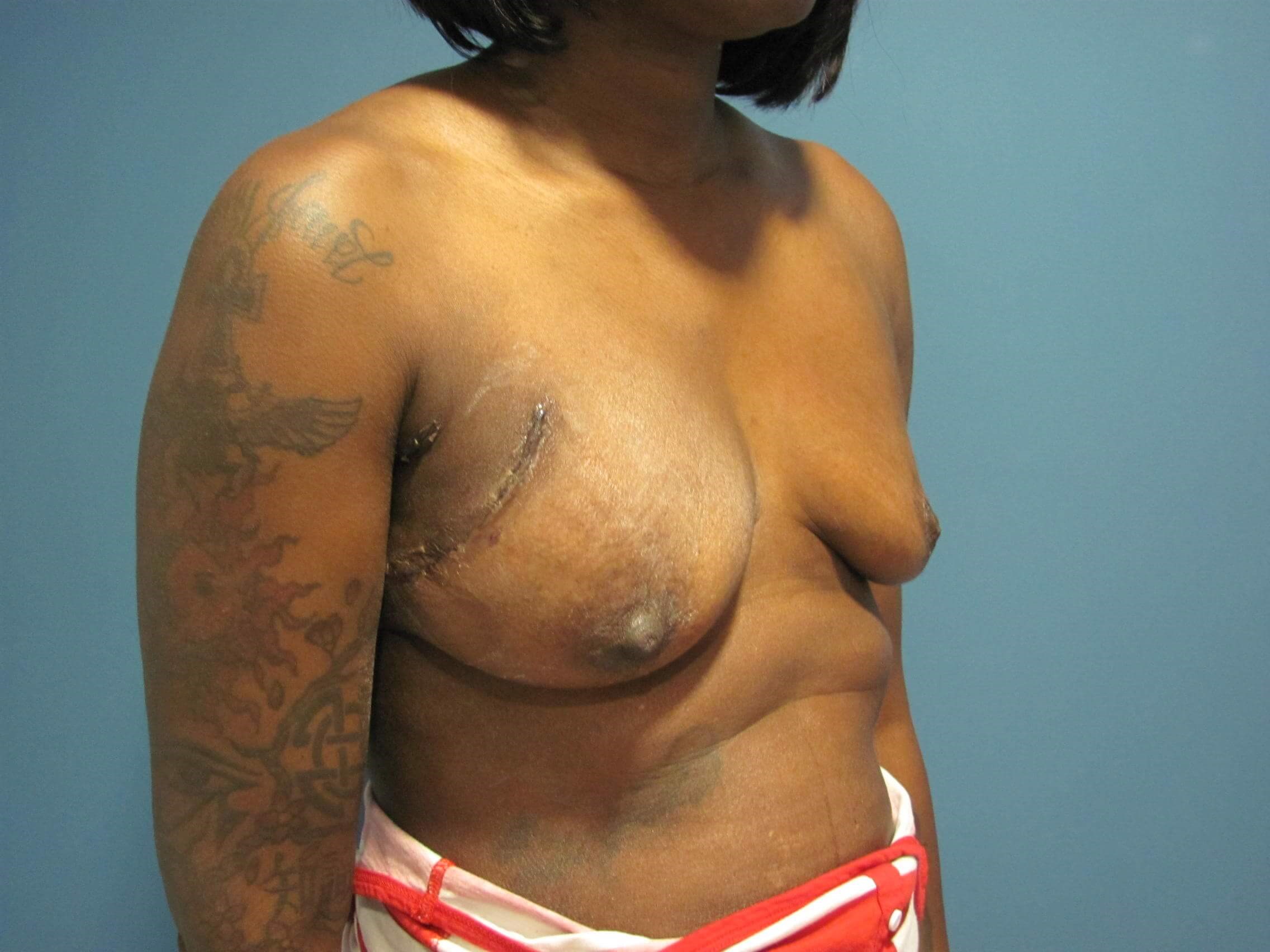 Breast Reconstruction in Forty-Six Year-Old Woman with Expaner/implants — before, view 2