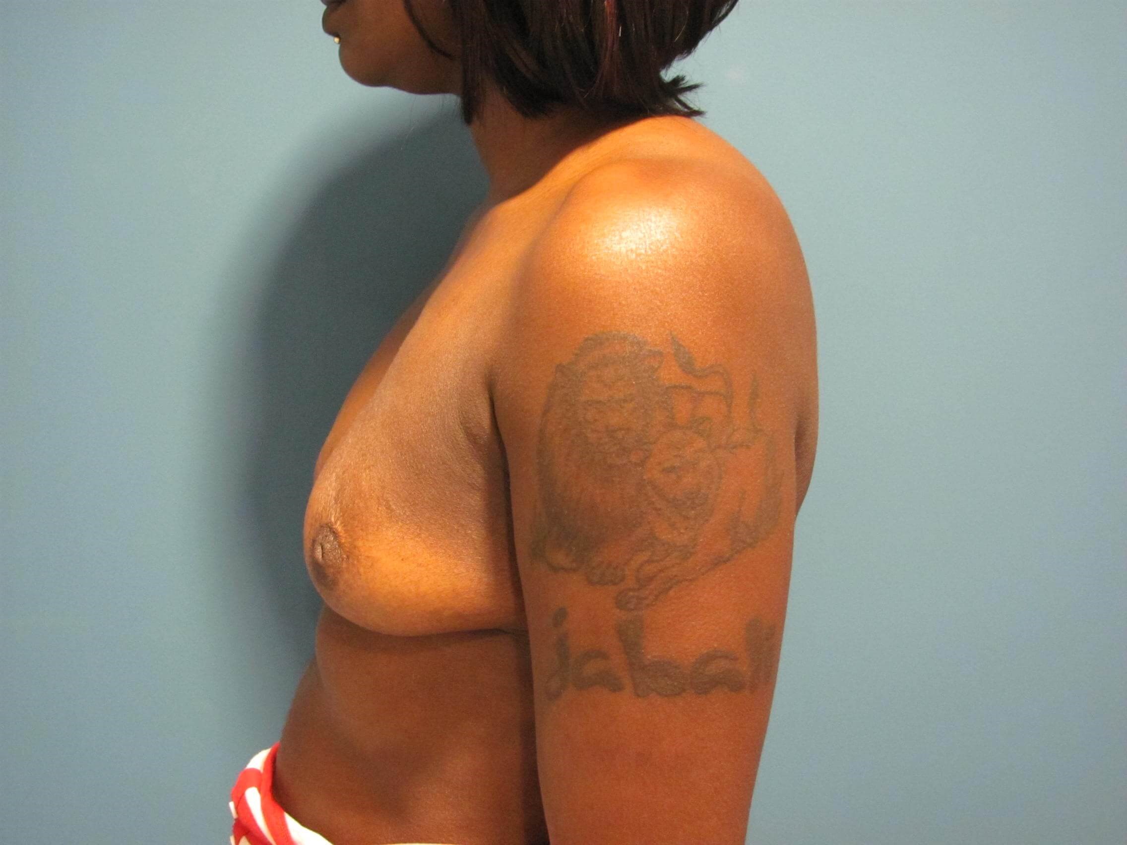 Breast Reconstruction in Forty-Six Year-Old Woman with Expaner/implants — before, view 4