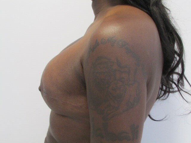 Breast Reconstruction in Forty-Six Year-Old Woman with Expaner/implants — after, view 4