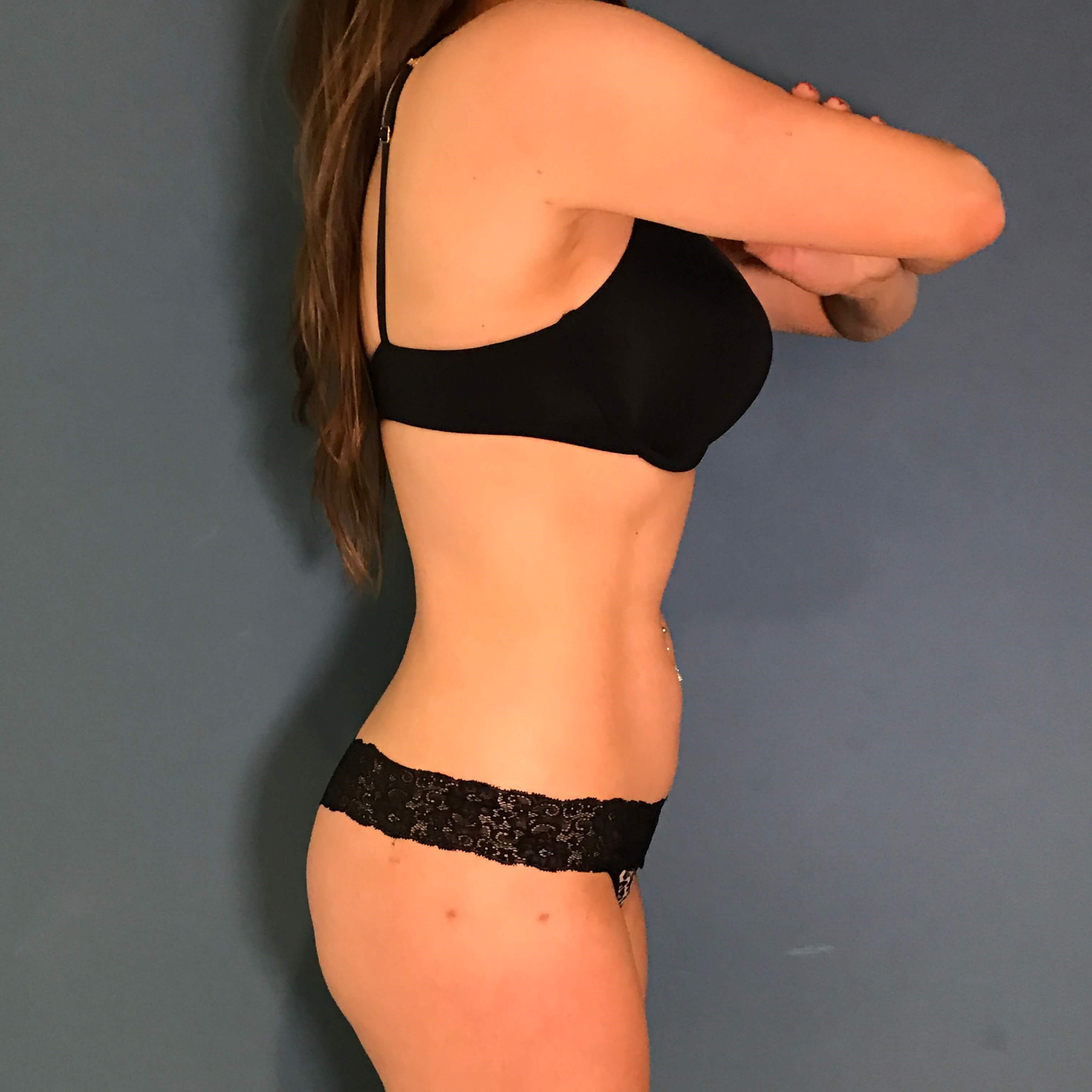 Full Body Liposculpture of a Forty-Four Year-Old Woman — after, view 2