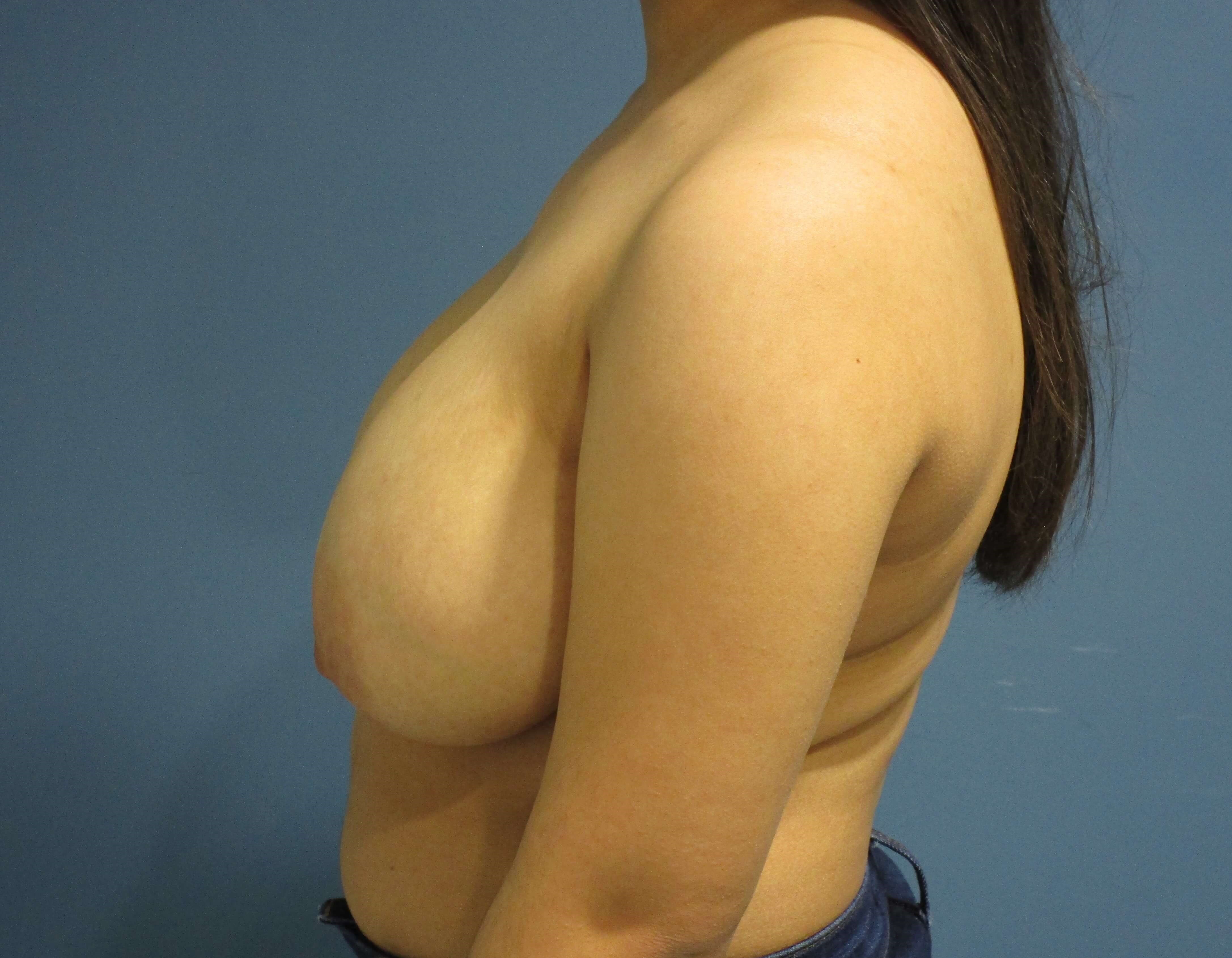 A Twenty-One Year-Old Woman Three Months After Breast Reduction — before, view 3