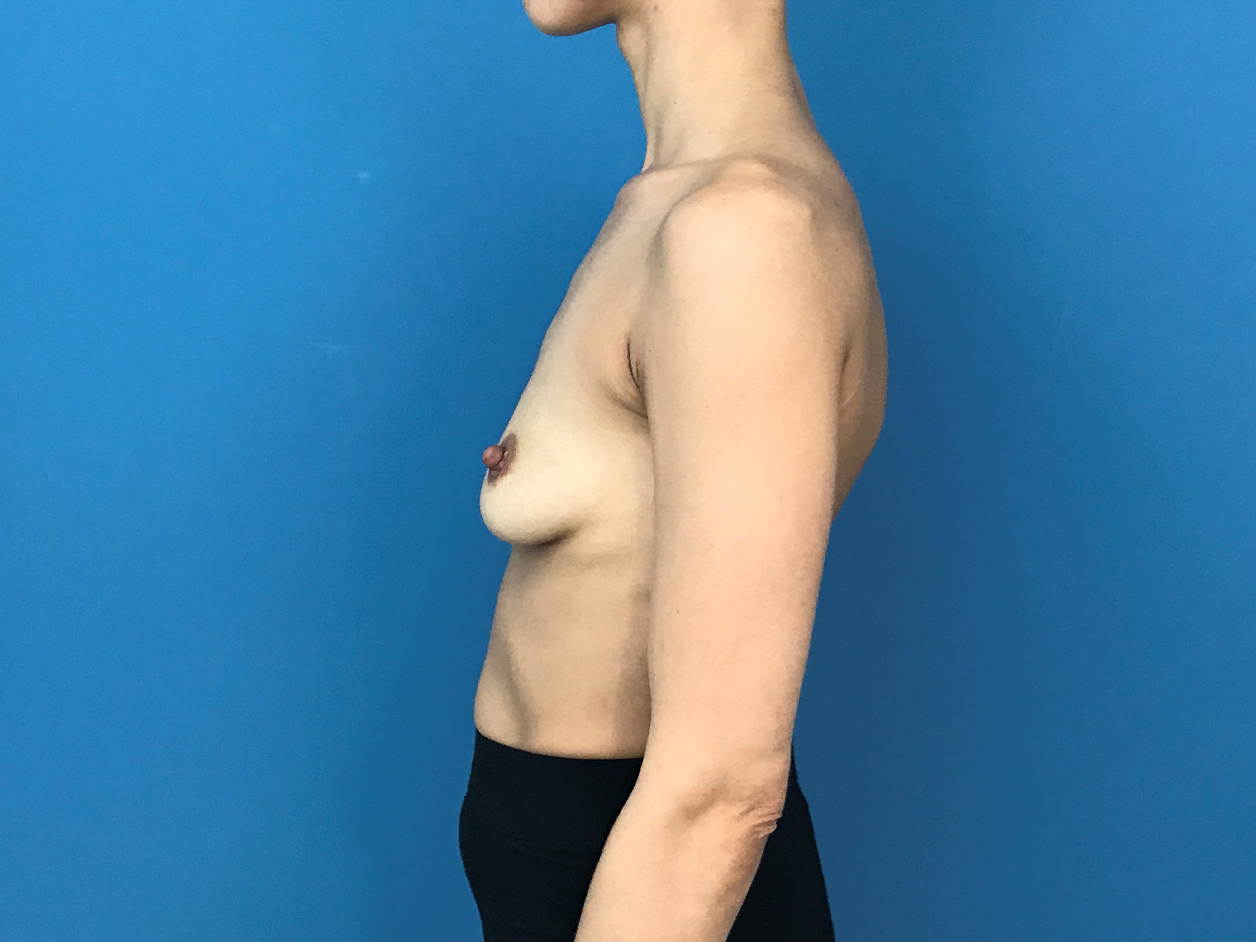 Bilateral Breast Augmentation From A to C Cup with High Profile Implants — before, view 2