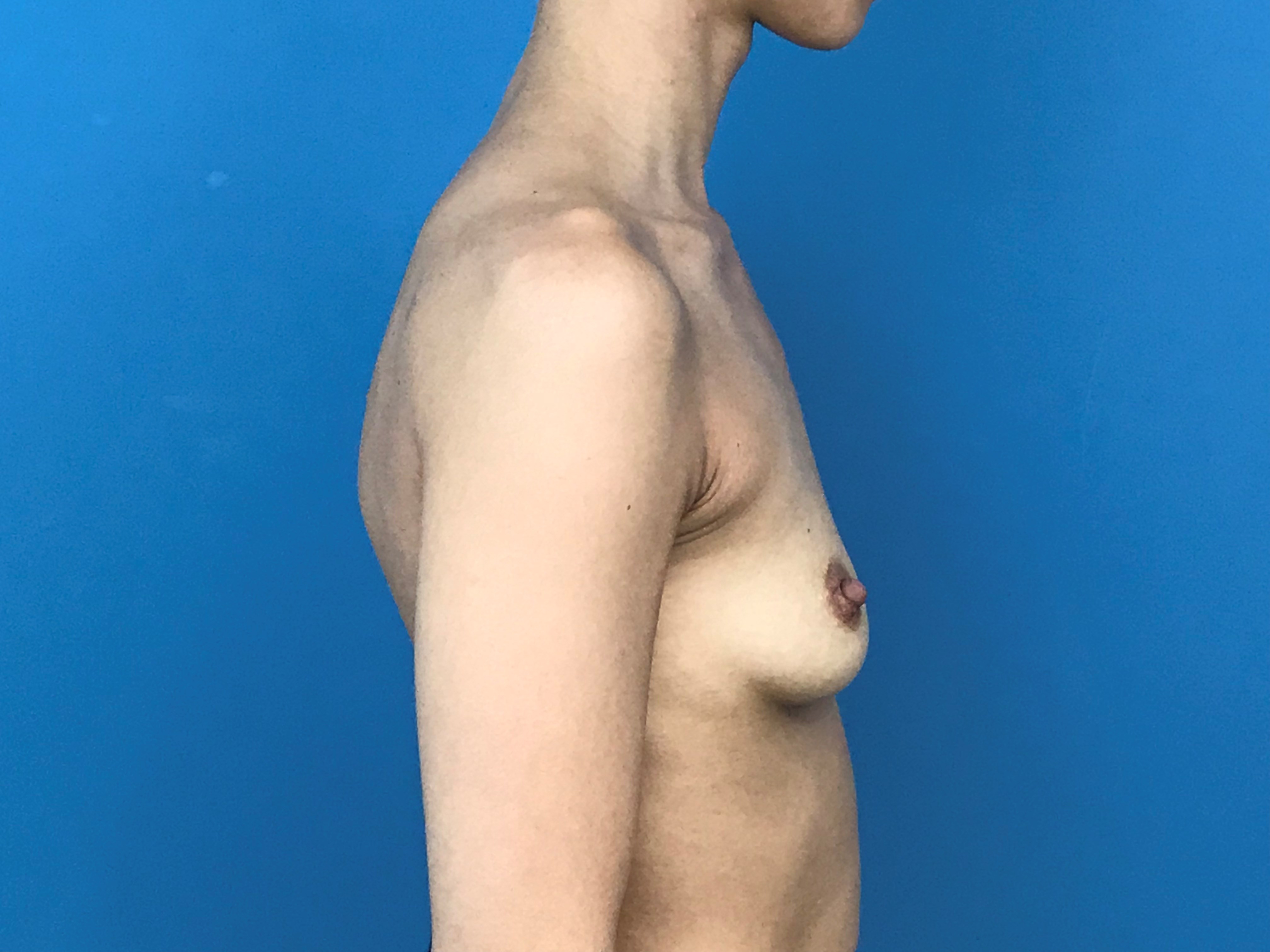 Bilateral Breast Augmentation From A to C Cup with High Profile Implants — before, view 4