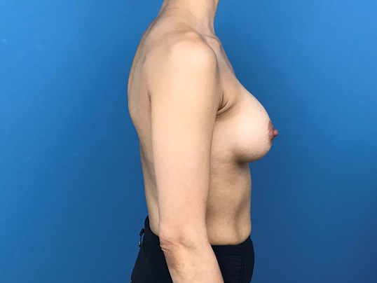 Bilateral Breast Augmentation From A to C Cup with High Profile Implants — after, view 4
