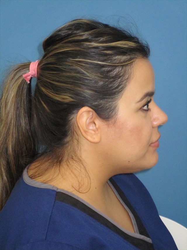 Neck Slim Procedure — before, view 2
