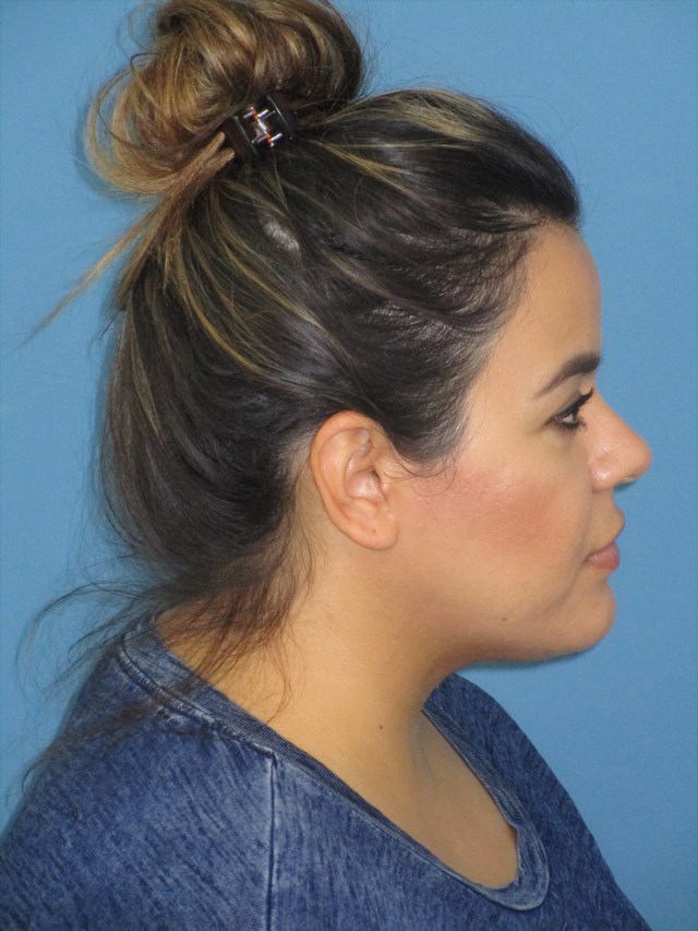 Neck Slim Procedure — after, view 2