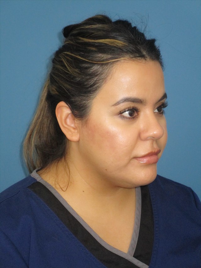 Neck Slim Procedure — before, view 3