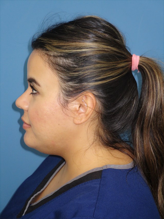 Neck Slim Procedure — before, view 4