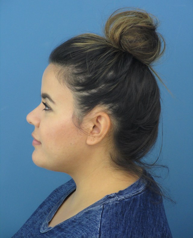 Neck Slim Procedure — after, view 4