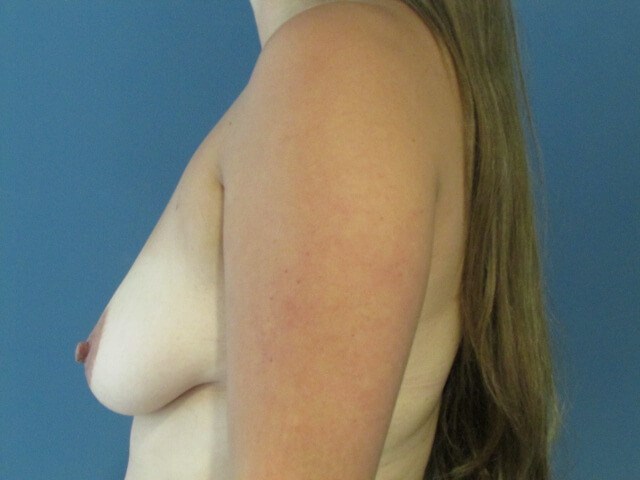 Bilateral Mastopexy/augmentation C Cup Breasts with Fat Transfer — before, view 4