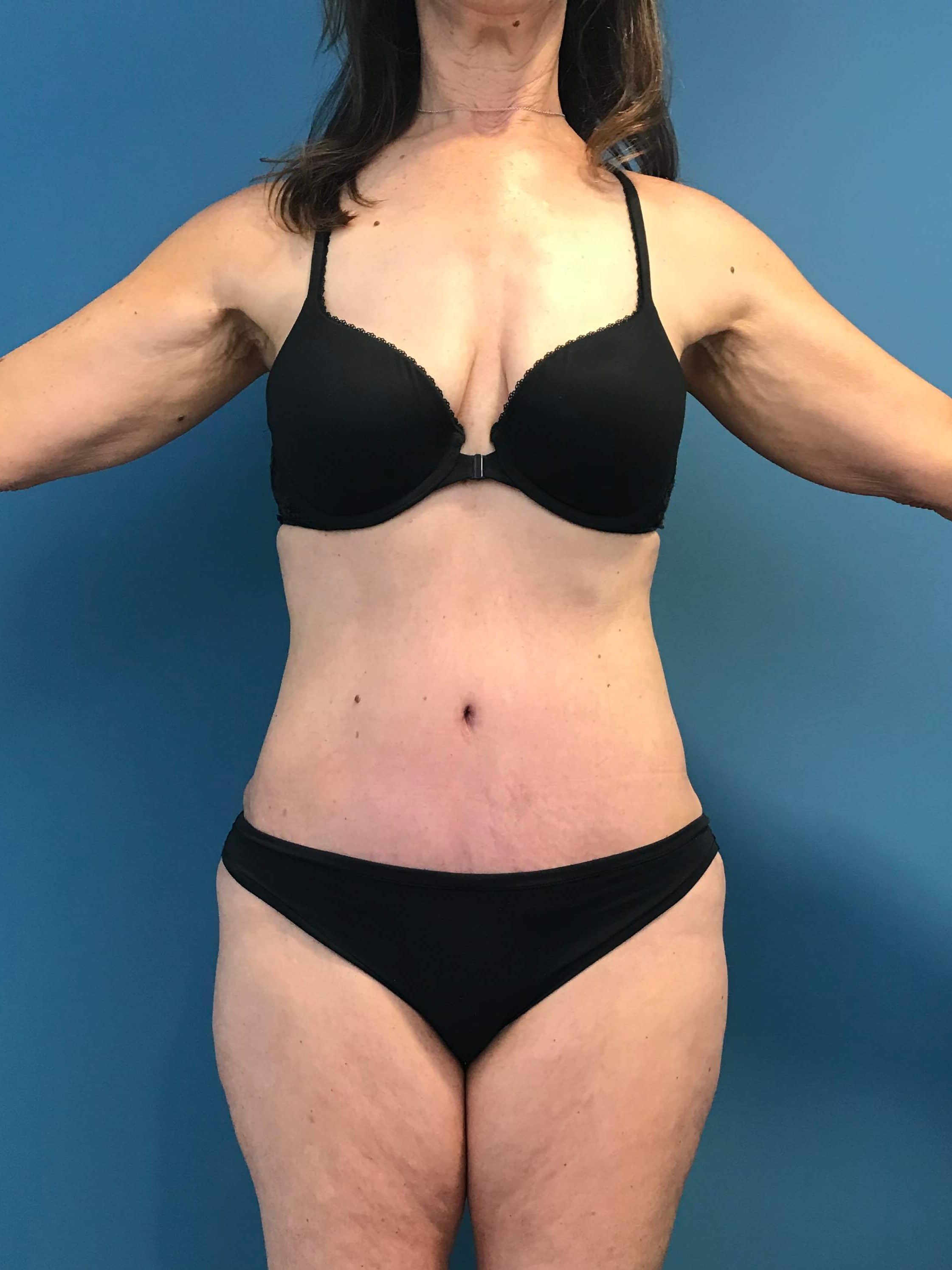 Abdominoplasty with Rectus Plication — after, view 2