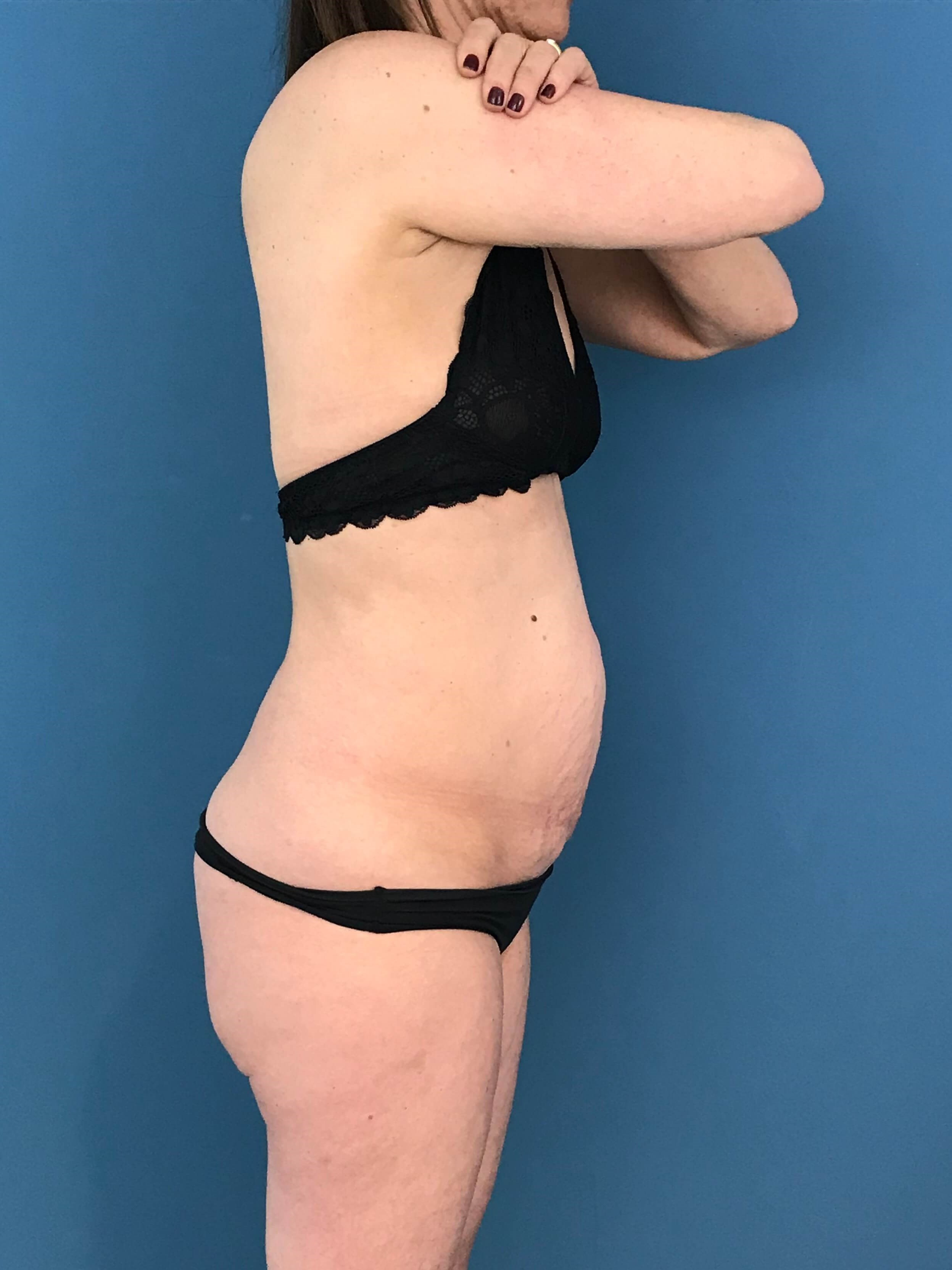 Abdominoplasty with Rectus Plication — before, view 3