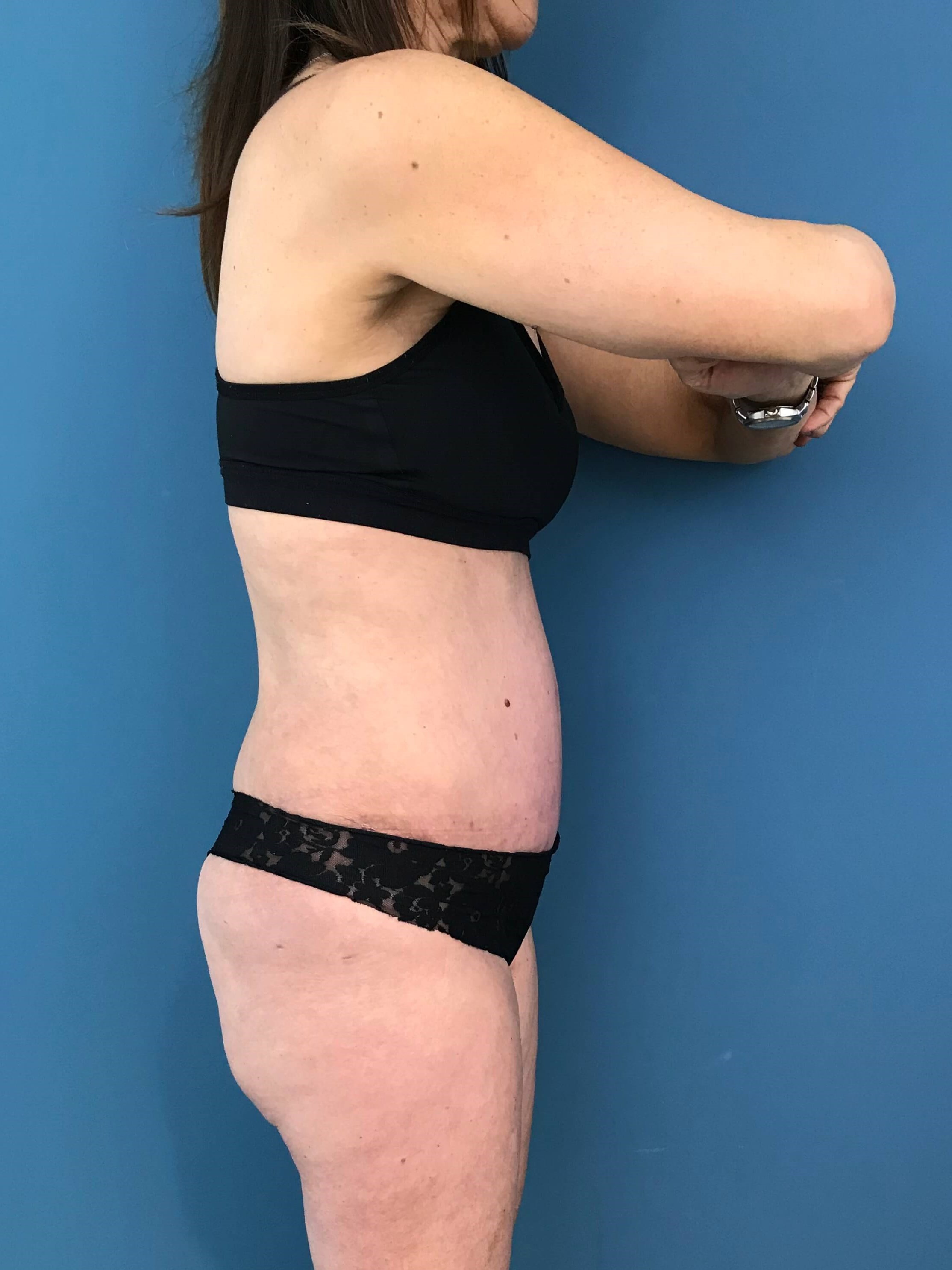 Abdominoplasty with Rectus Plication — after, view 4