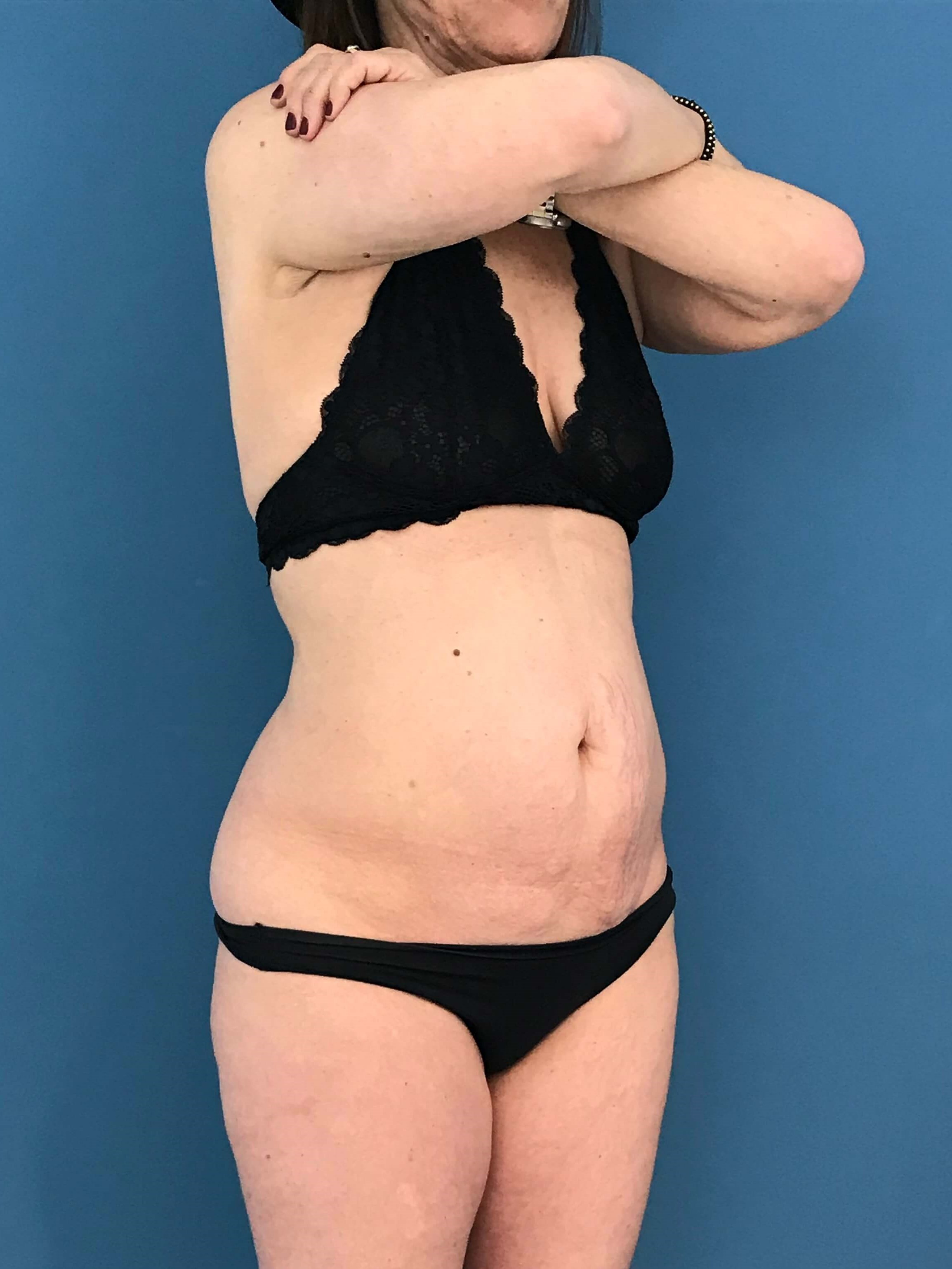 Abdominoplasty with Rectus Plication — before, view 5