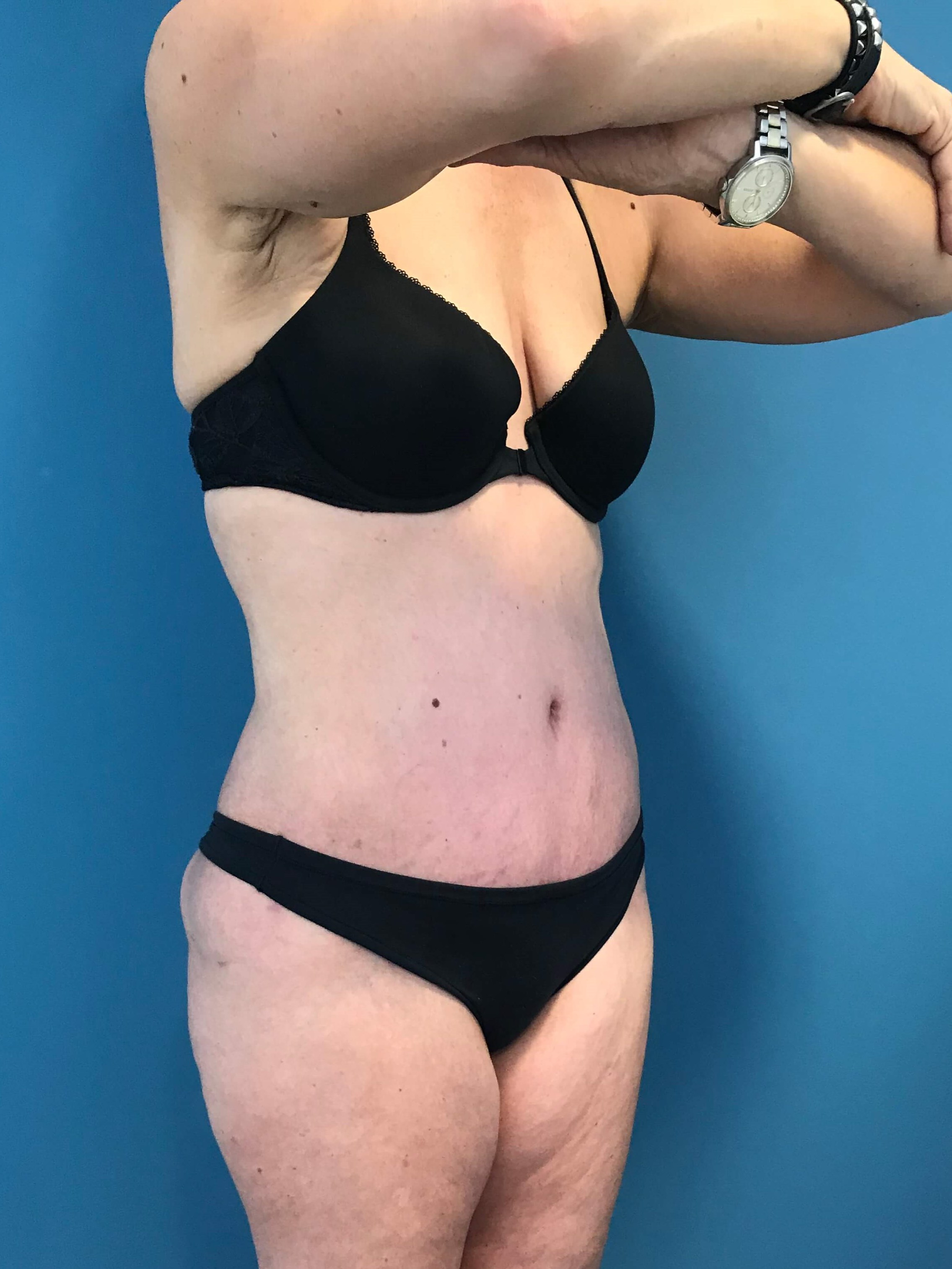 Abdominoplasty with Rectus Plication