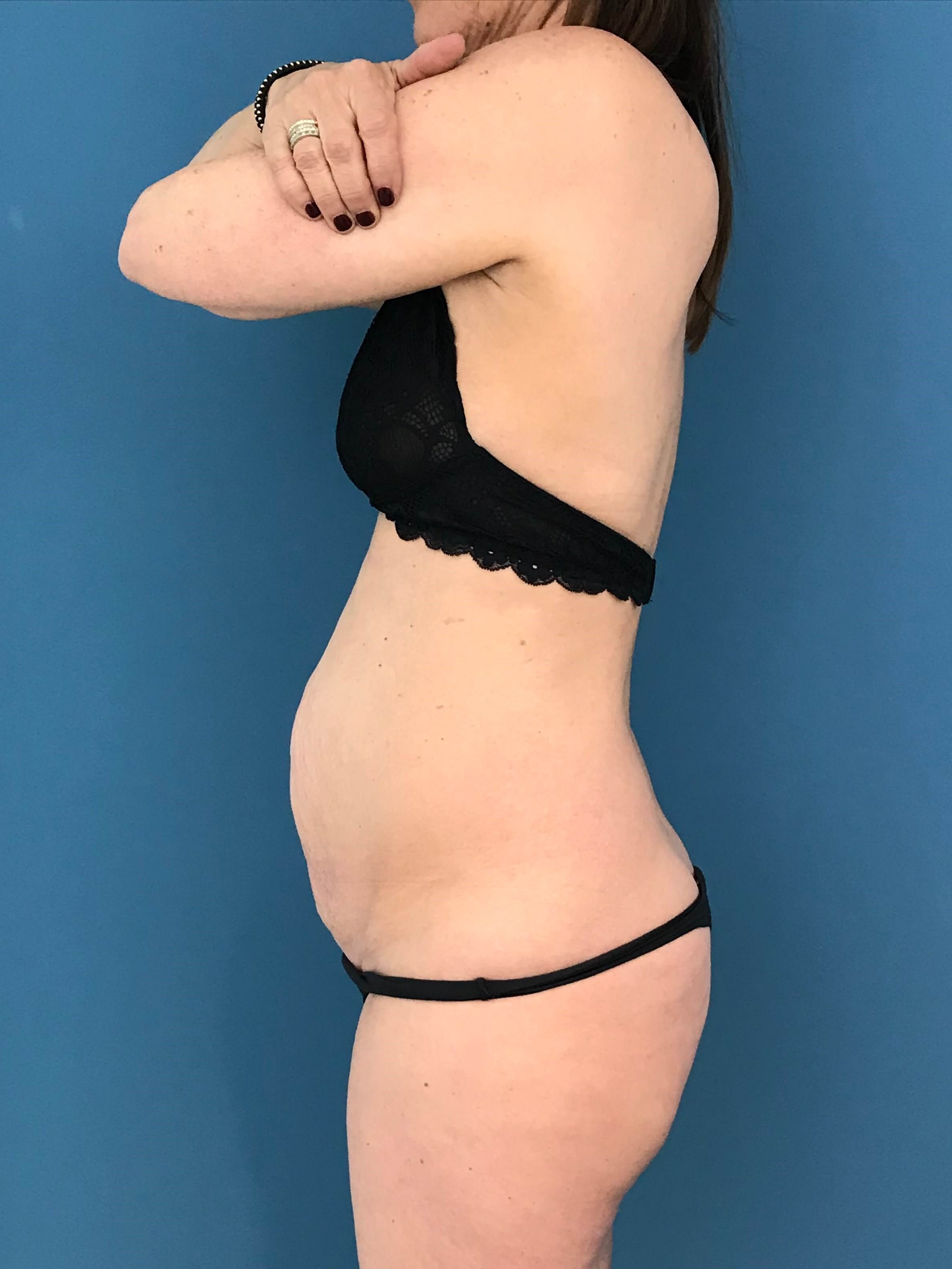 Abdominoplasty with Rectus Plication — before, view 2