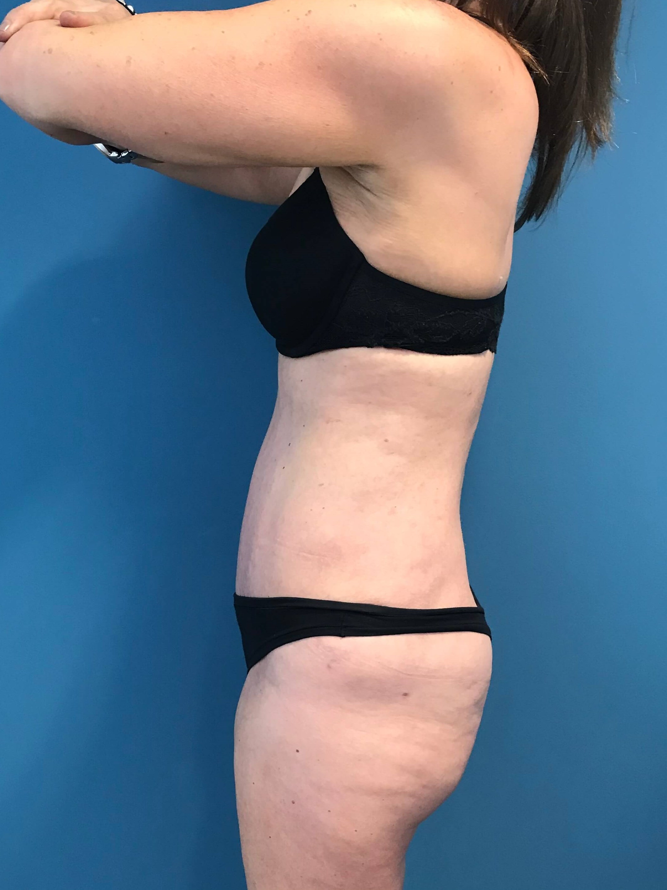 Abdominoplasty with Rectus Plication — after, view 3