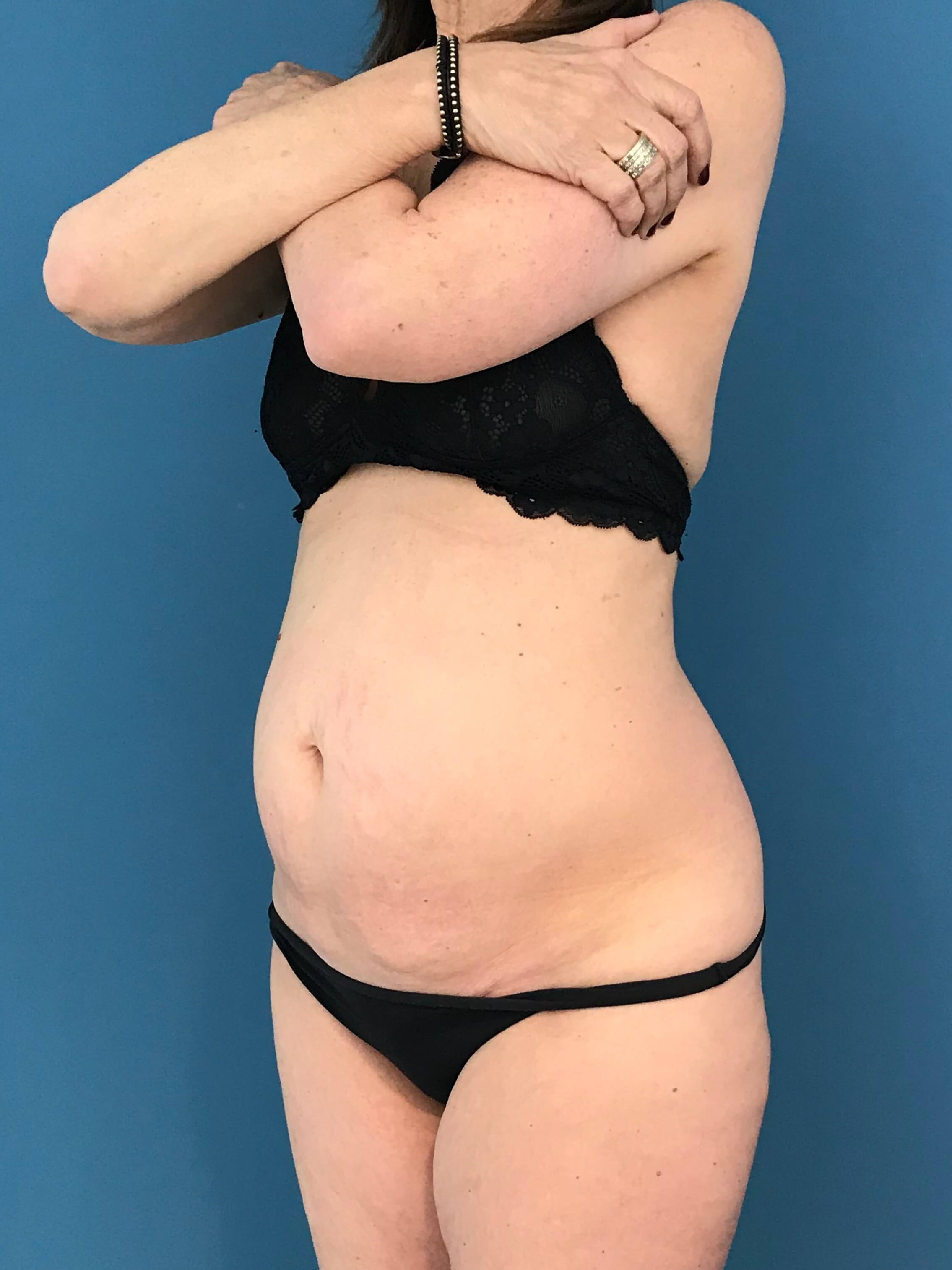 Abdominoplasty with Rectus Plication — before, view 4