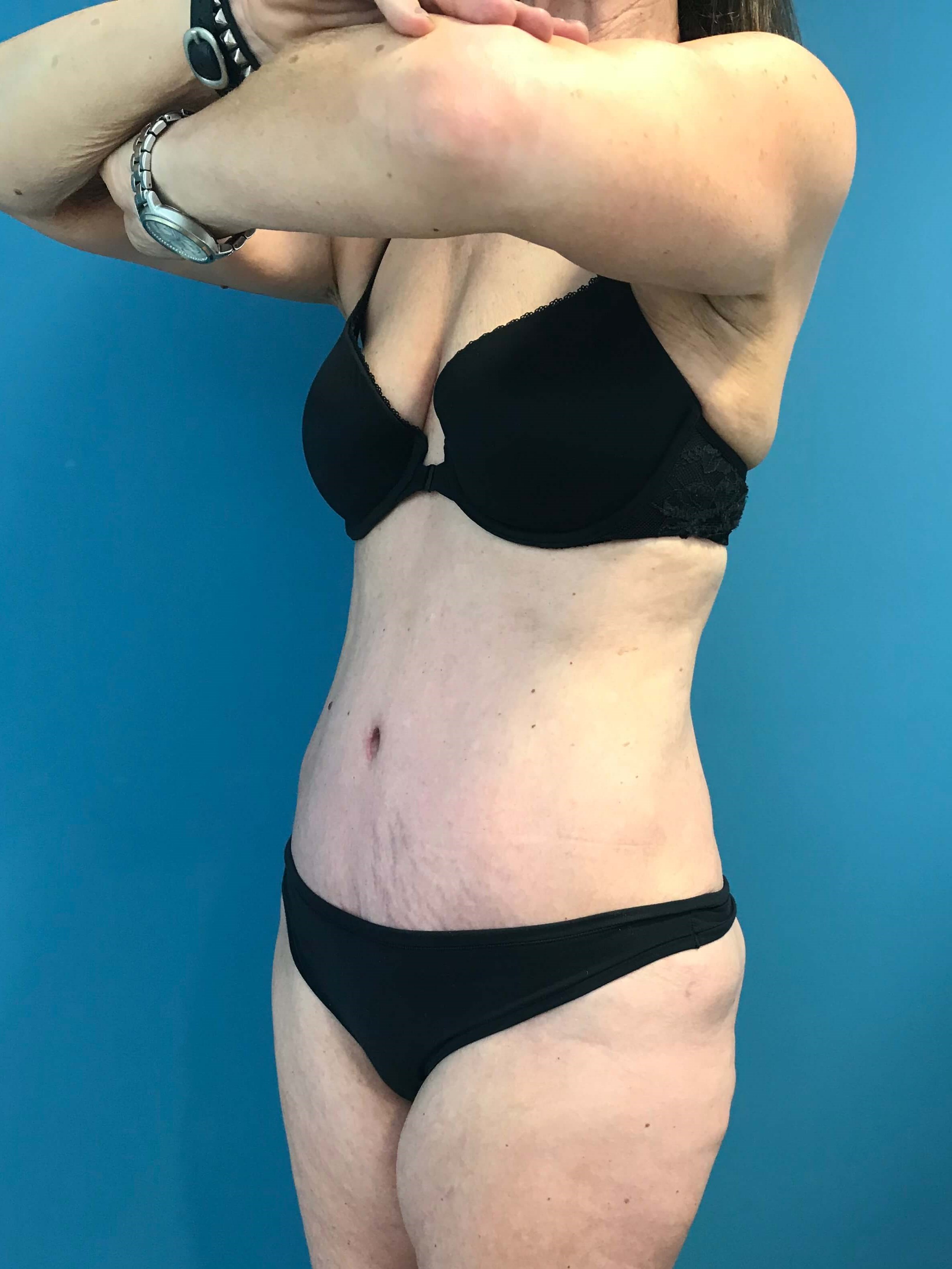 Abdominoplasty with Rectus Plication — after, view 5