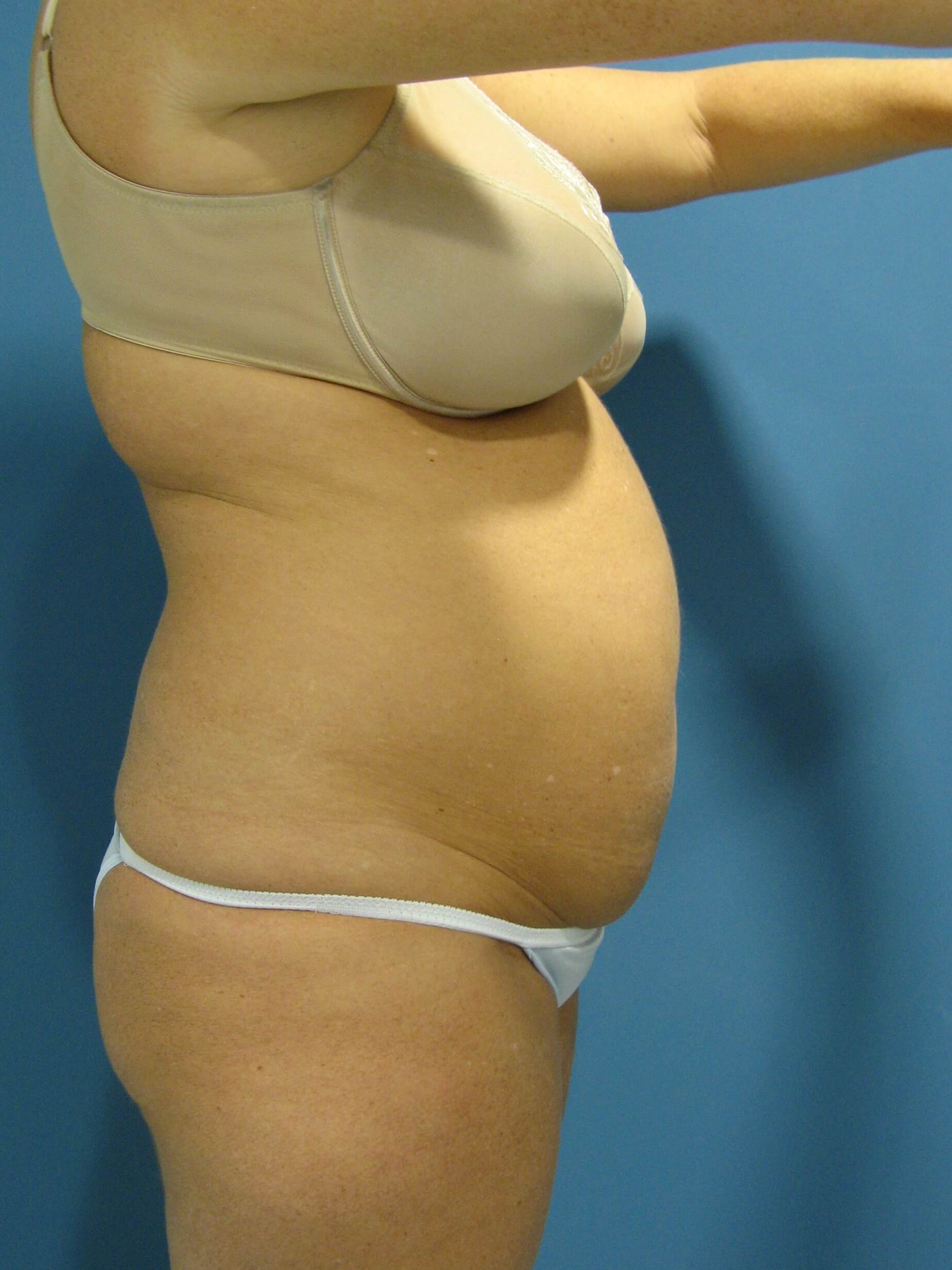 Abdominoplasty with Rectus Plication — before, view 2