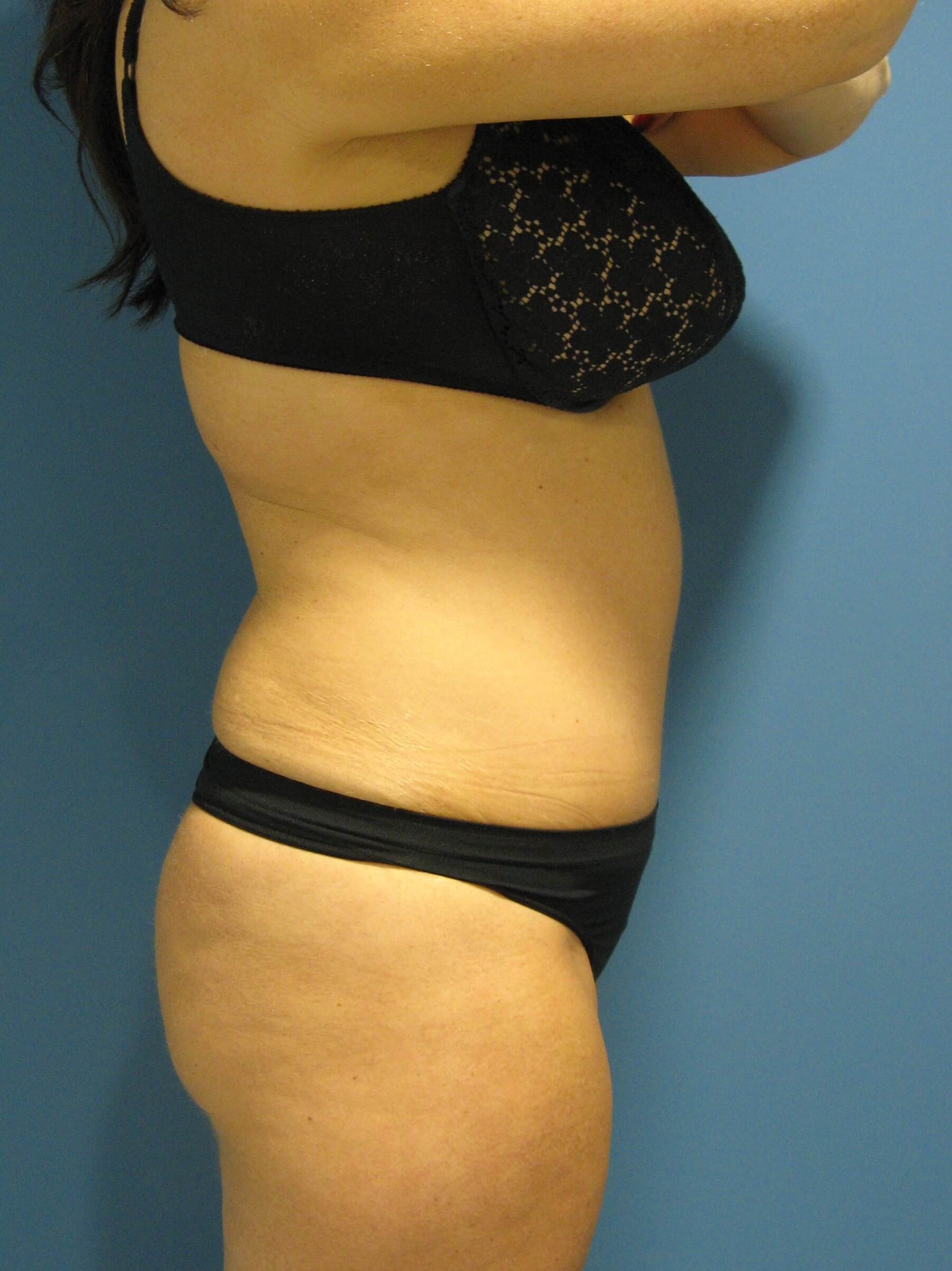 Abdominoplasty with Rectus Plication — after, view 2