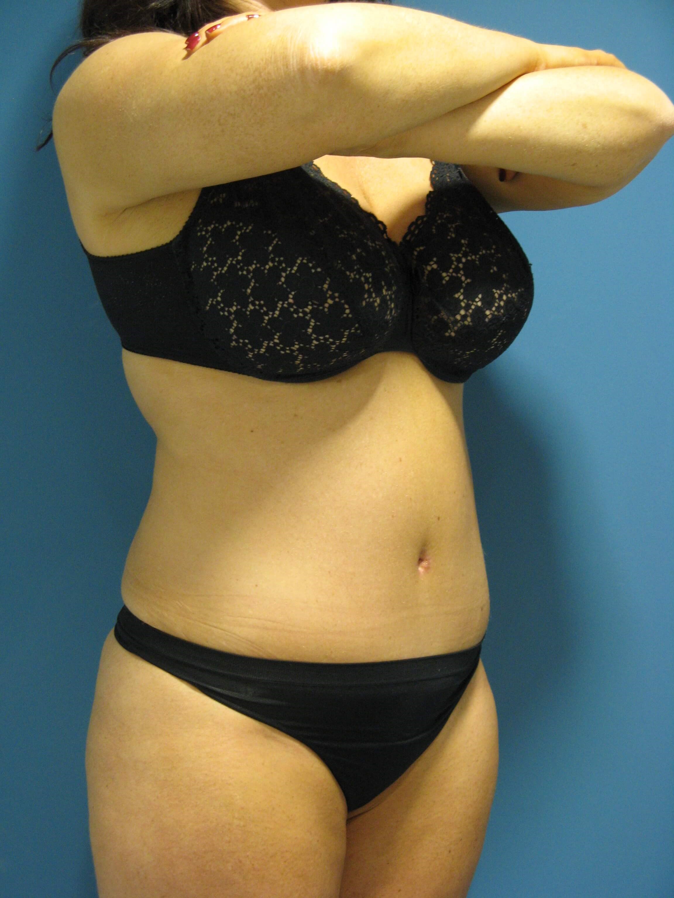 Abdominoplasty with Rectus Plication — after, view 4