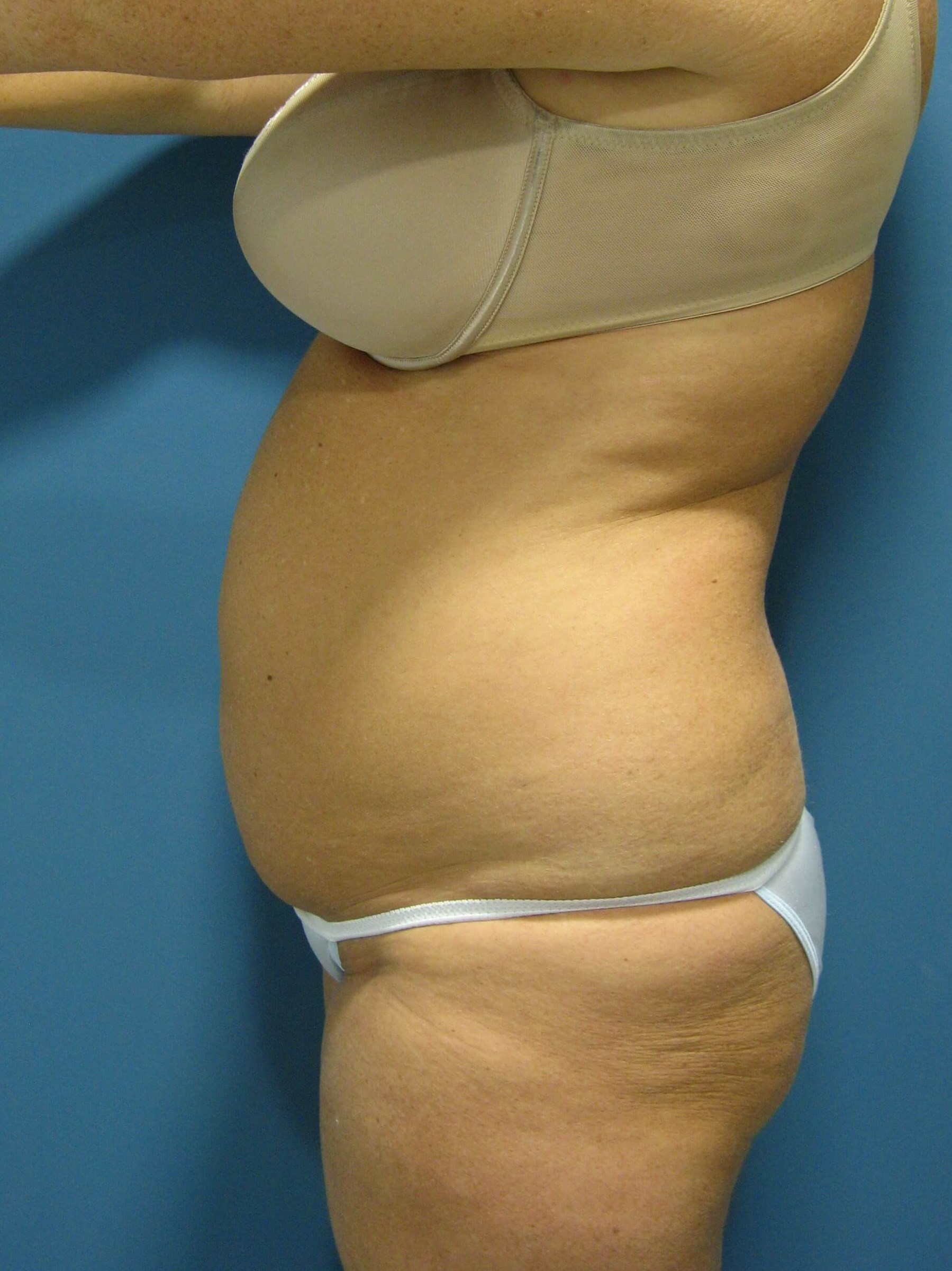 Abdominoplasty with Rectus Plication — before, view 3