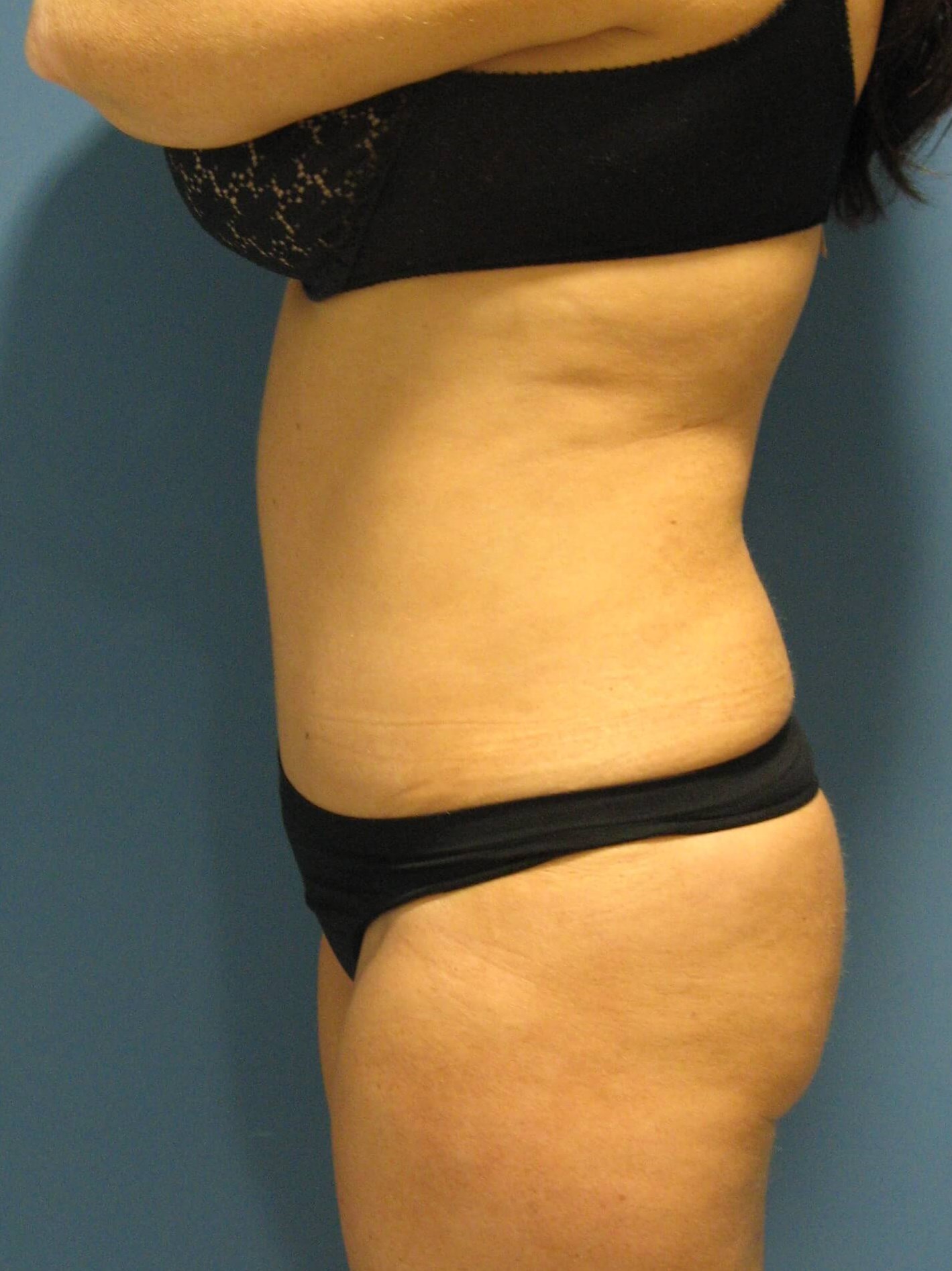 Abdominoplasty with Rectus Plication — after, view 3