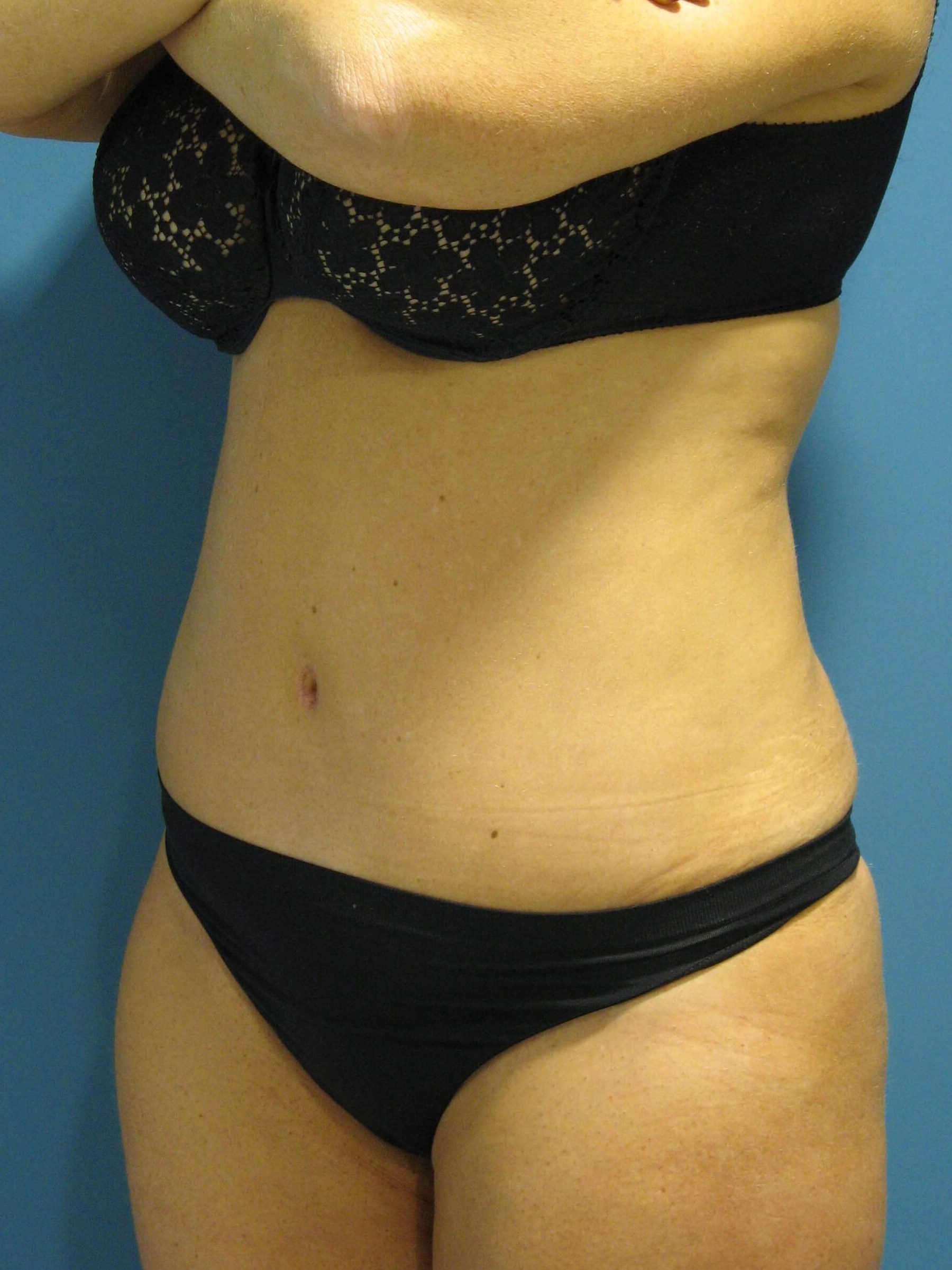 Abdominoplasty with Rectus Plication — after, view 5