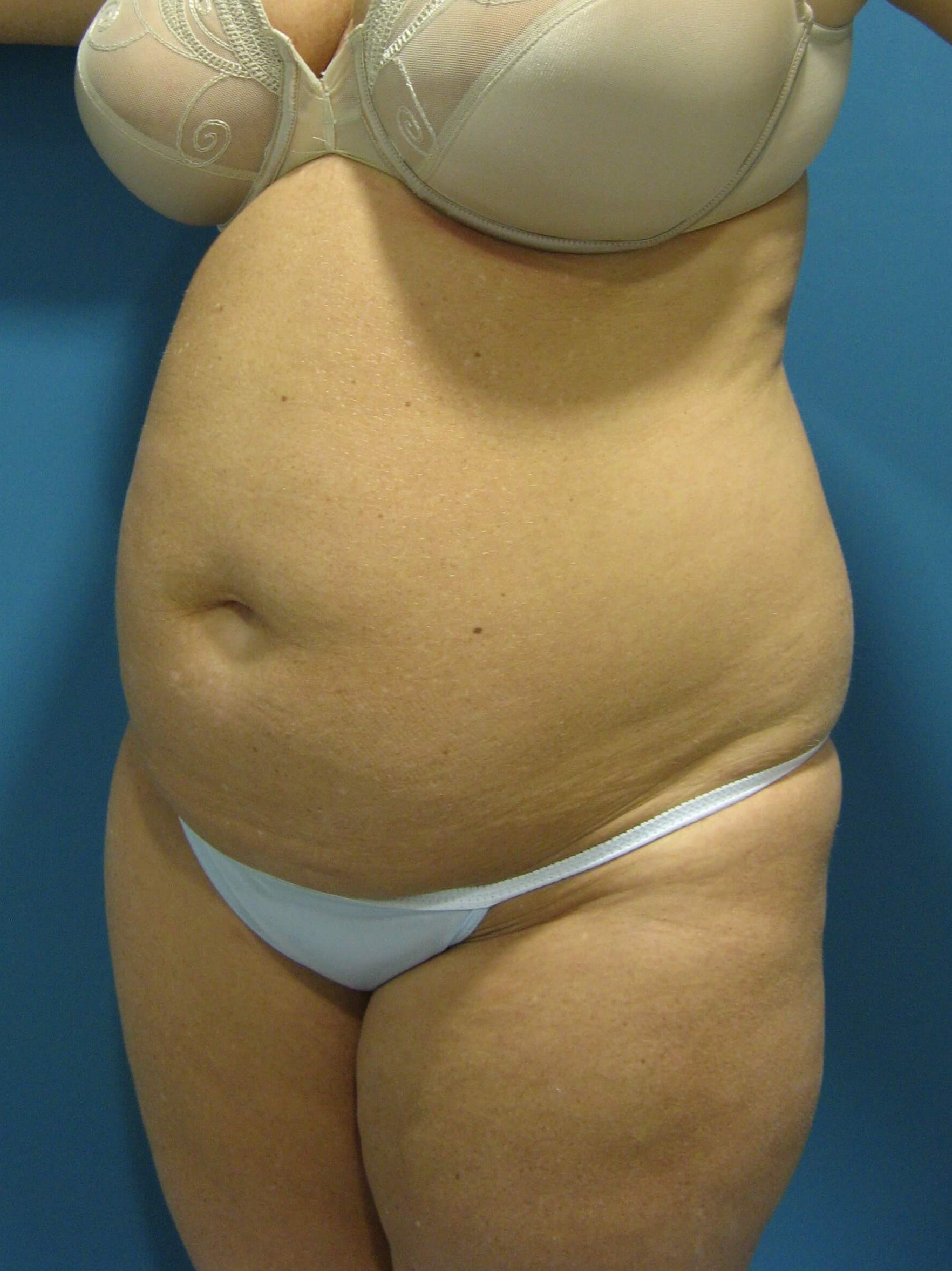 Abdominoplasty with Rectus Plication — before, view 5