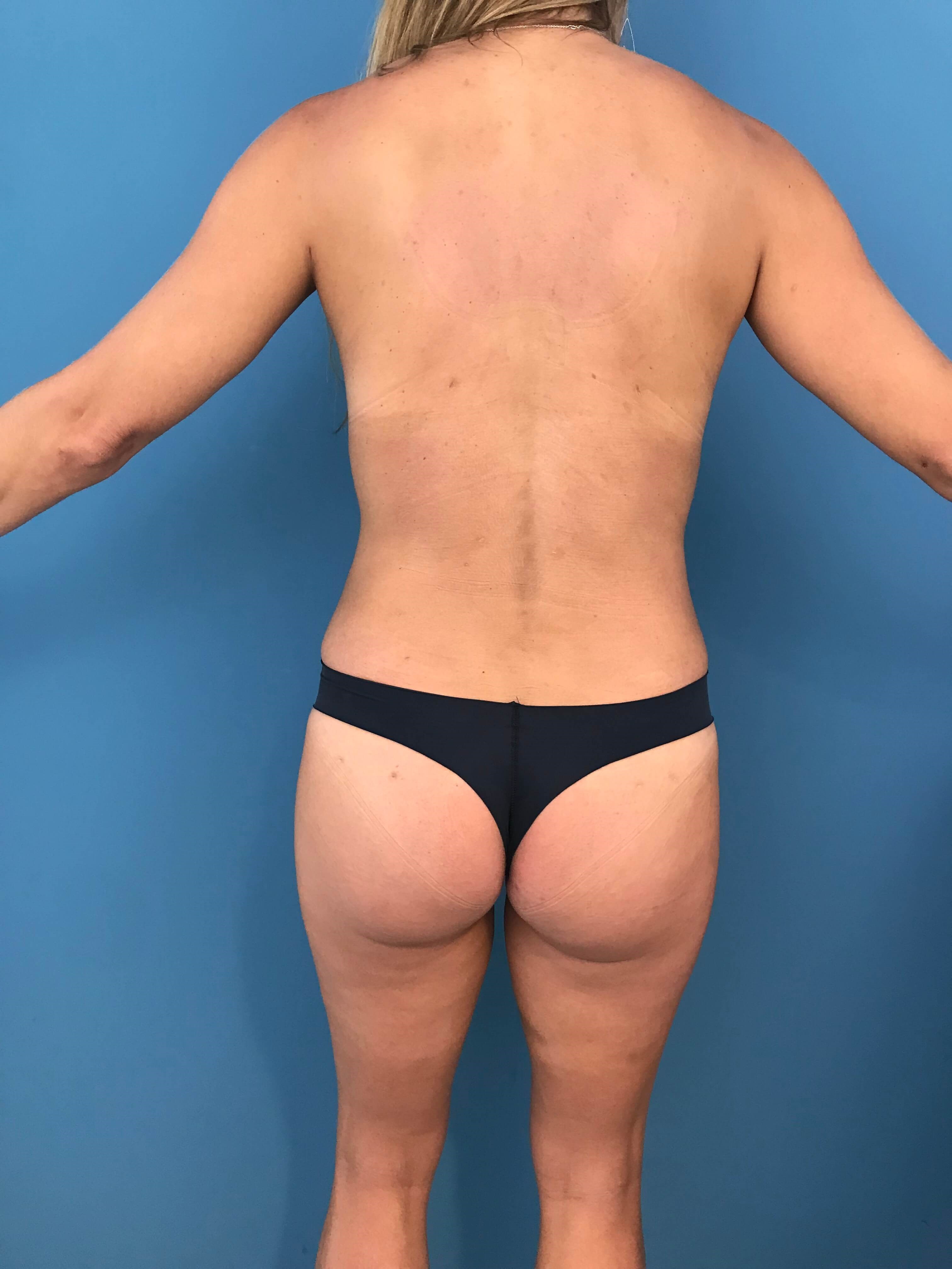 Mommy Makeover with Mastopexy/augmentation, Tummy Tuck and Liposuction — after, view 6