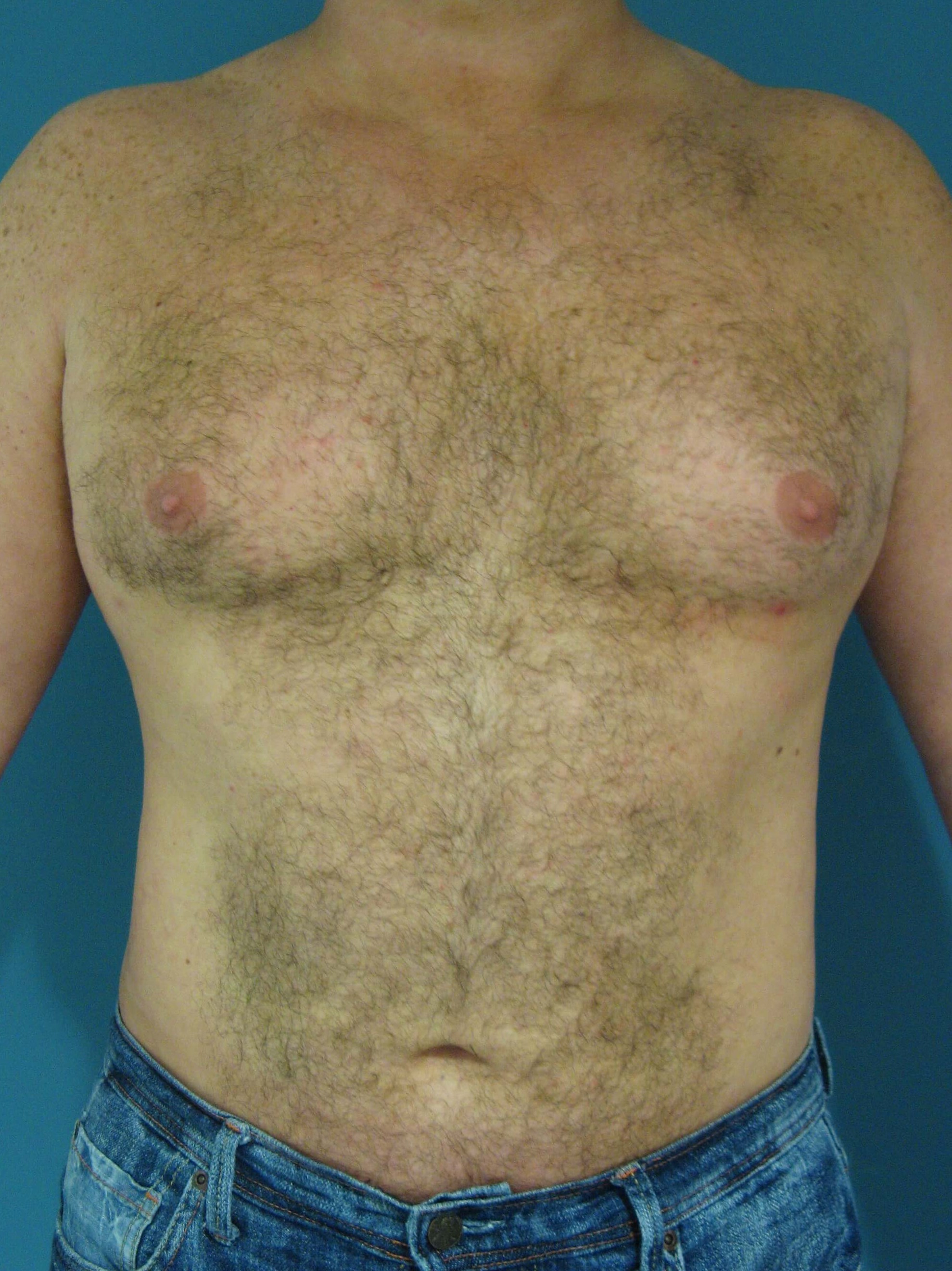 Male Liposuction of Abdomen, Flanks and Back — before, view 2