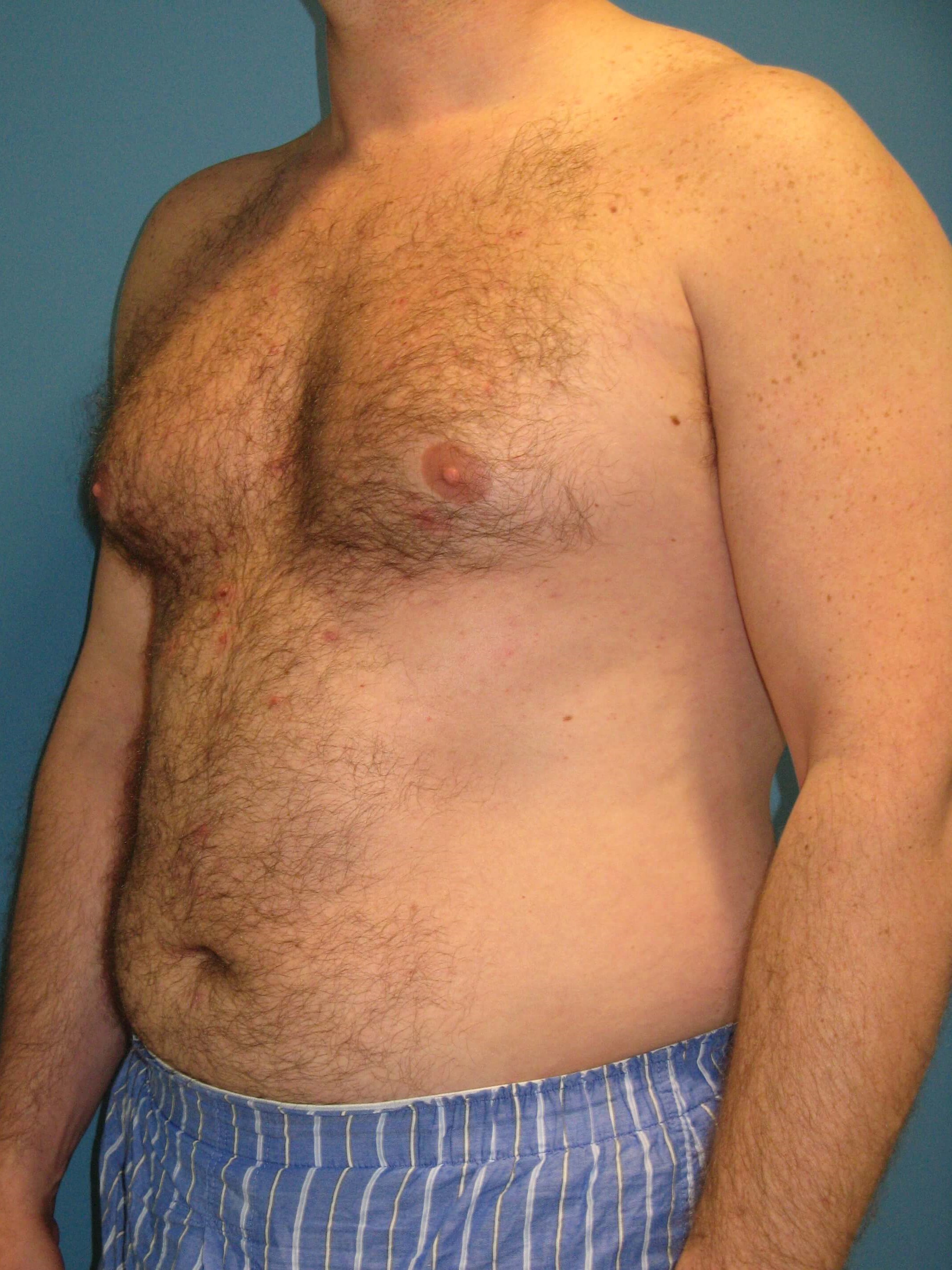 Male Liposuction of Abdomen, Flanks and Back — before, view 3