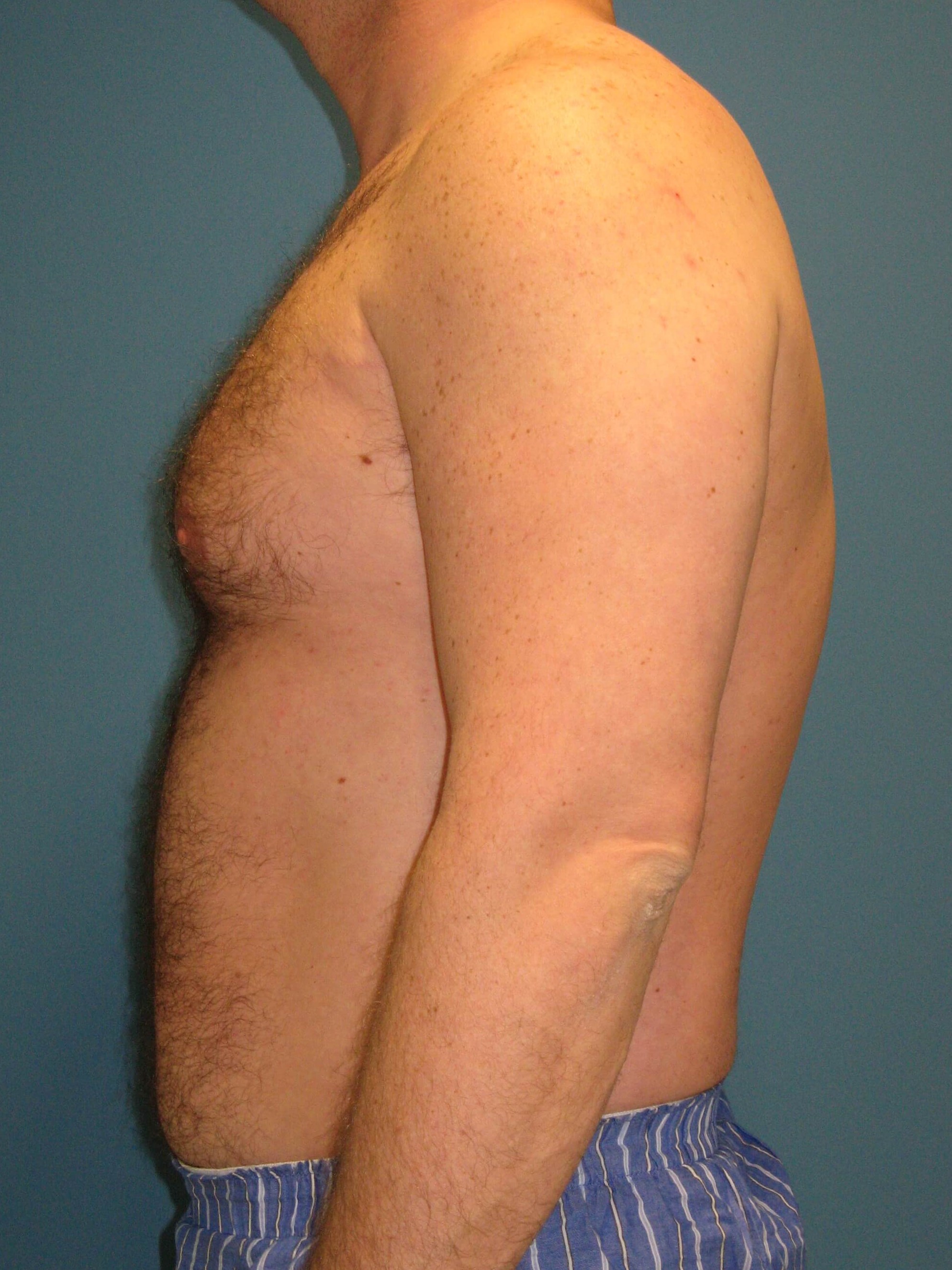 Male Liposuction of Abdomen, Flanks and Back — before, view 4