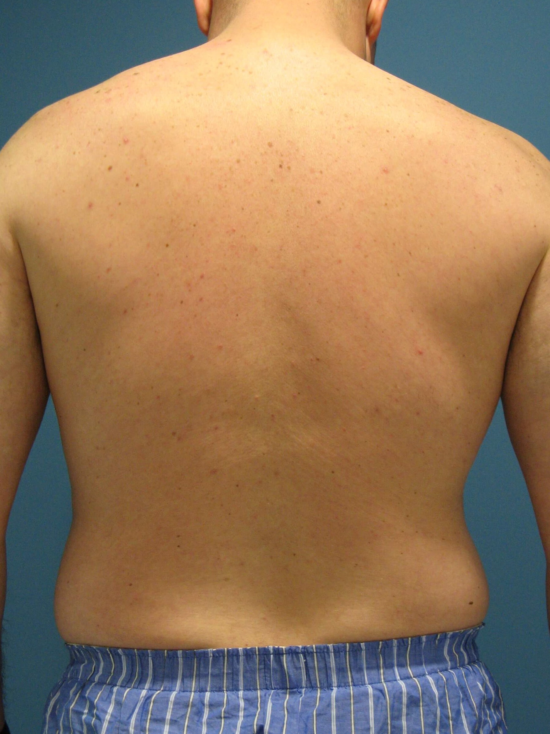 Male Liposuction of Abdomen, Flanks and Back — before, view 5