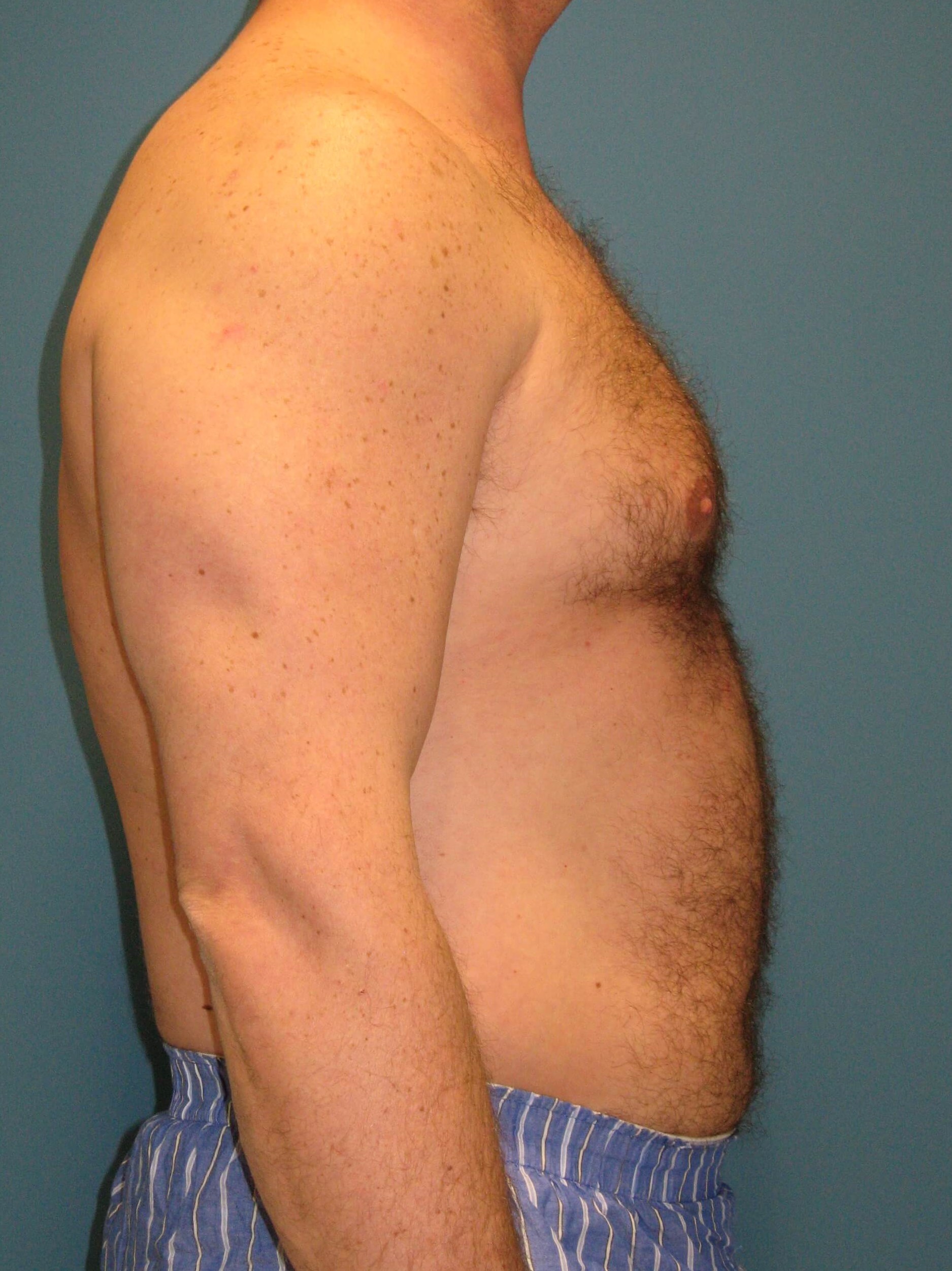 Male Liposuction of Abdomen, Flanks and Back — before, view 6